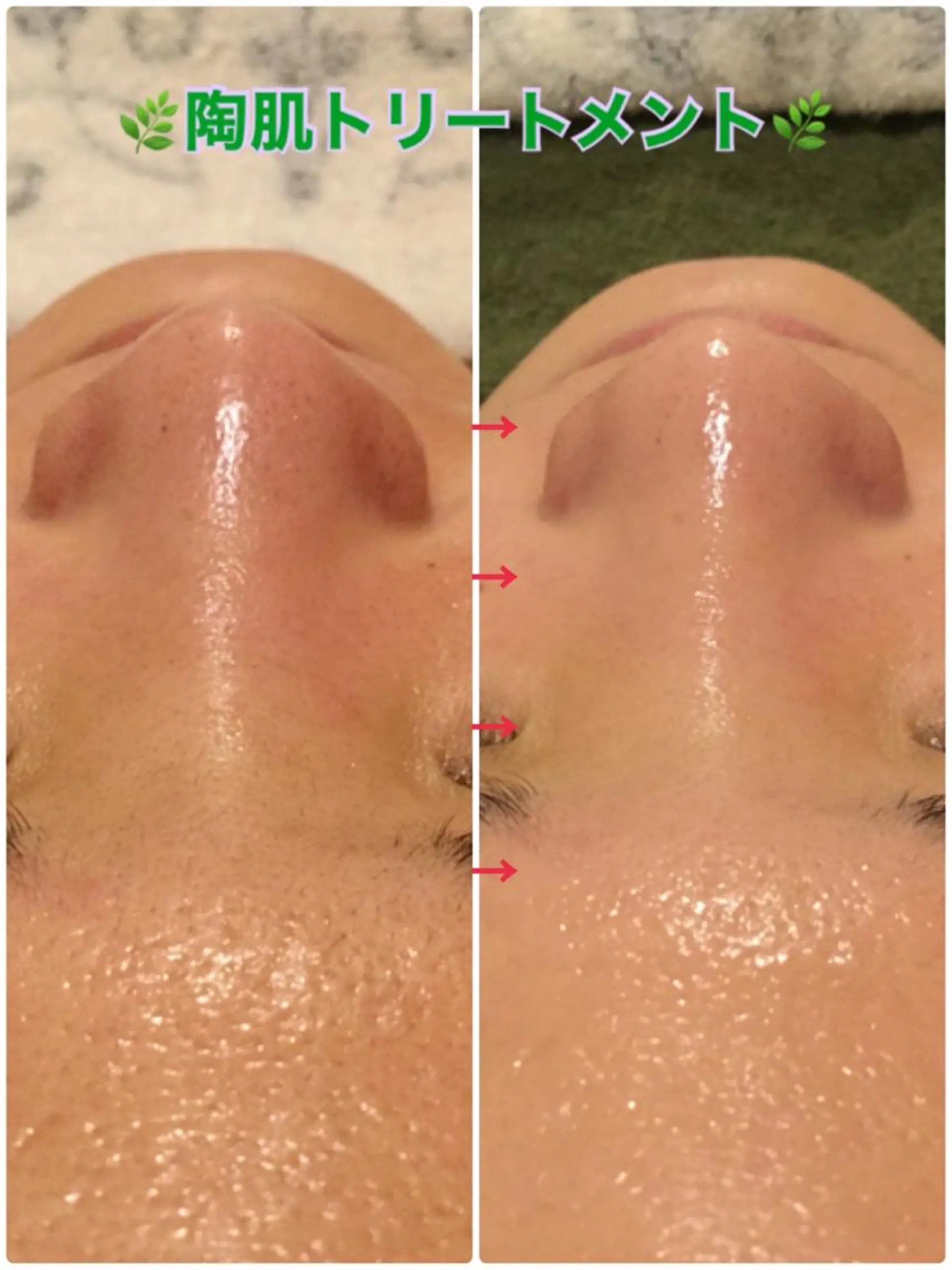 エステ 【リベルハーブピーリング認定店】敏感肌・美白脱毛専門店Dione立川店所属・Dione 立川店のエステ・リラクイメージ