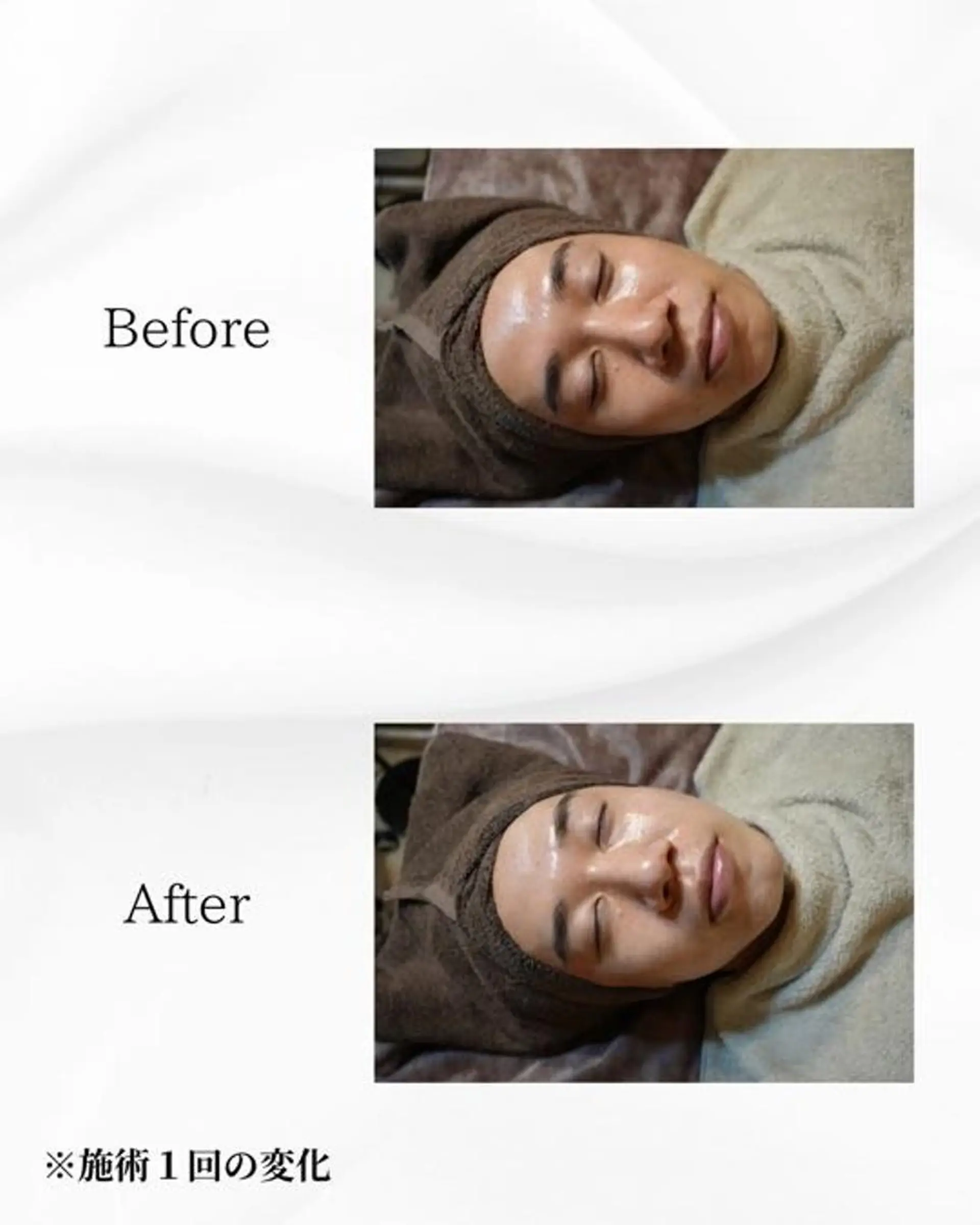 エステ ハーブピーリング🌿 REVI/Ayanoのエステ・リラクイメージ