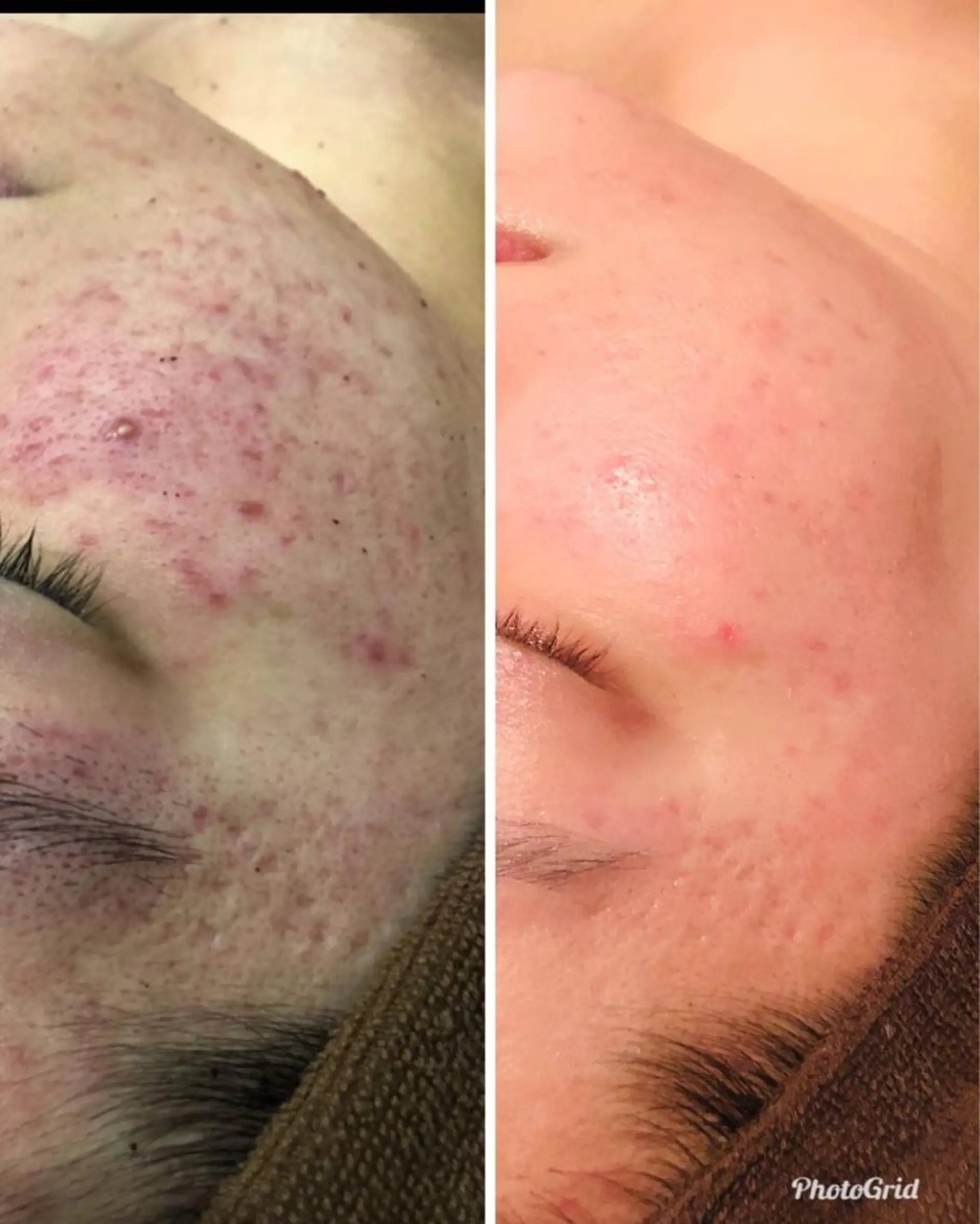 エステ 【リベルハーブピーリング認定店】敏感肌・美白脱毛専門店Dione立川店所属・Dione 立川店のエステ・リラクイメージ