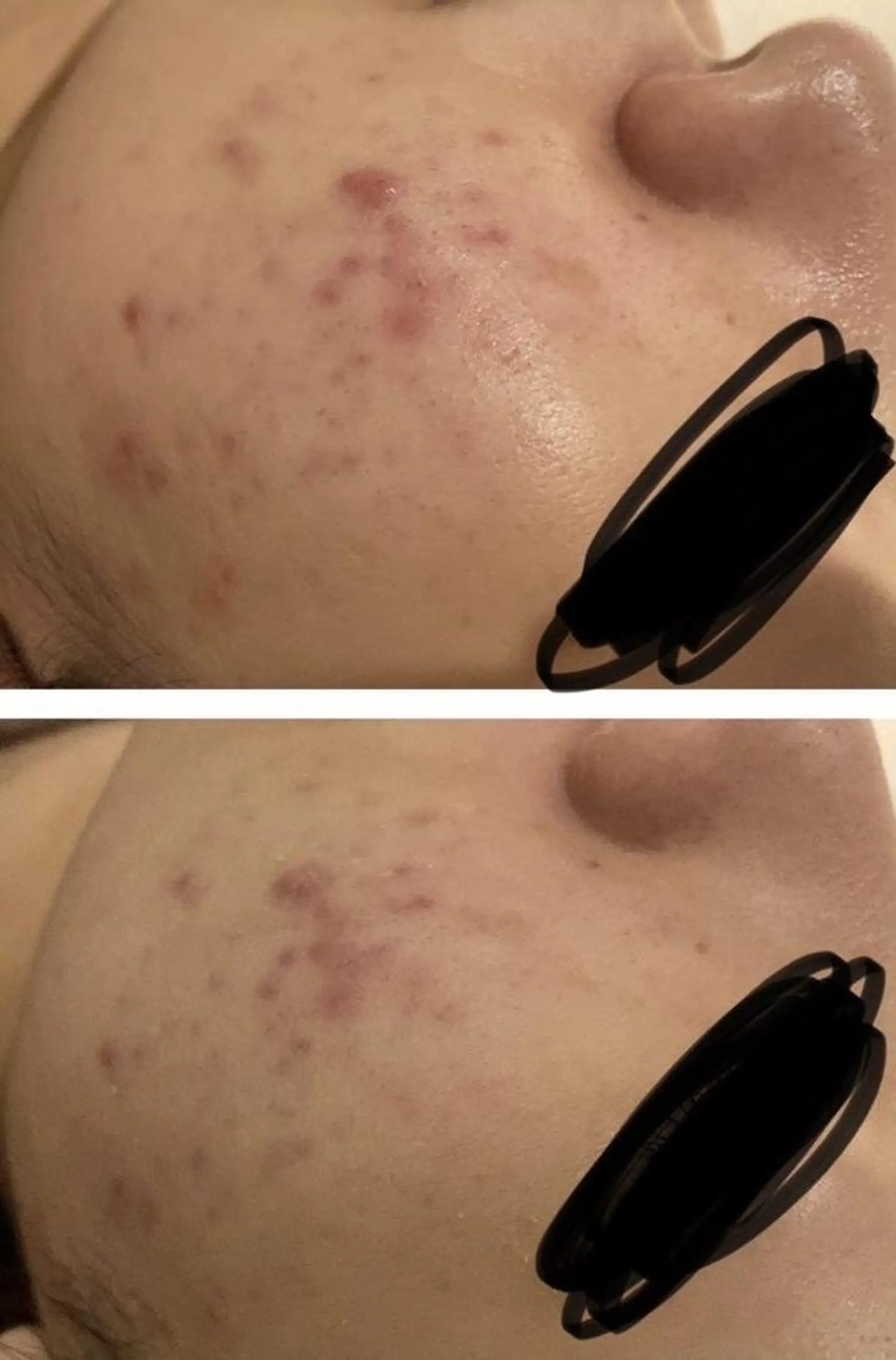 セミロング カラー パーマ ヘアアレンジ メンズ キッズ ネイル マツエク・マツパ アイブロウ エステ リラク ニキビ特化型エステ 🍋最短で肌質改善のエステ・リラクイメージ