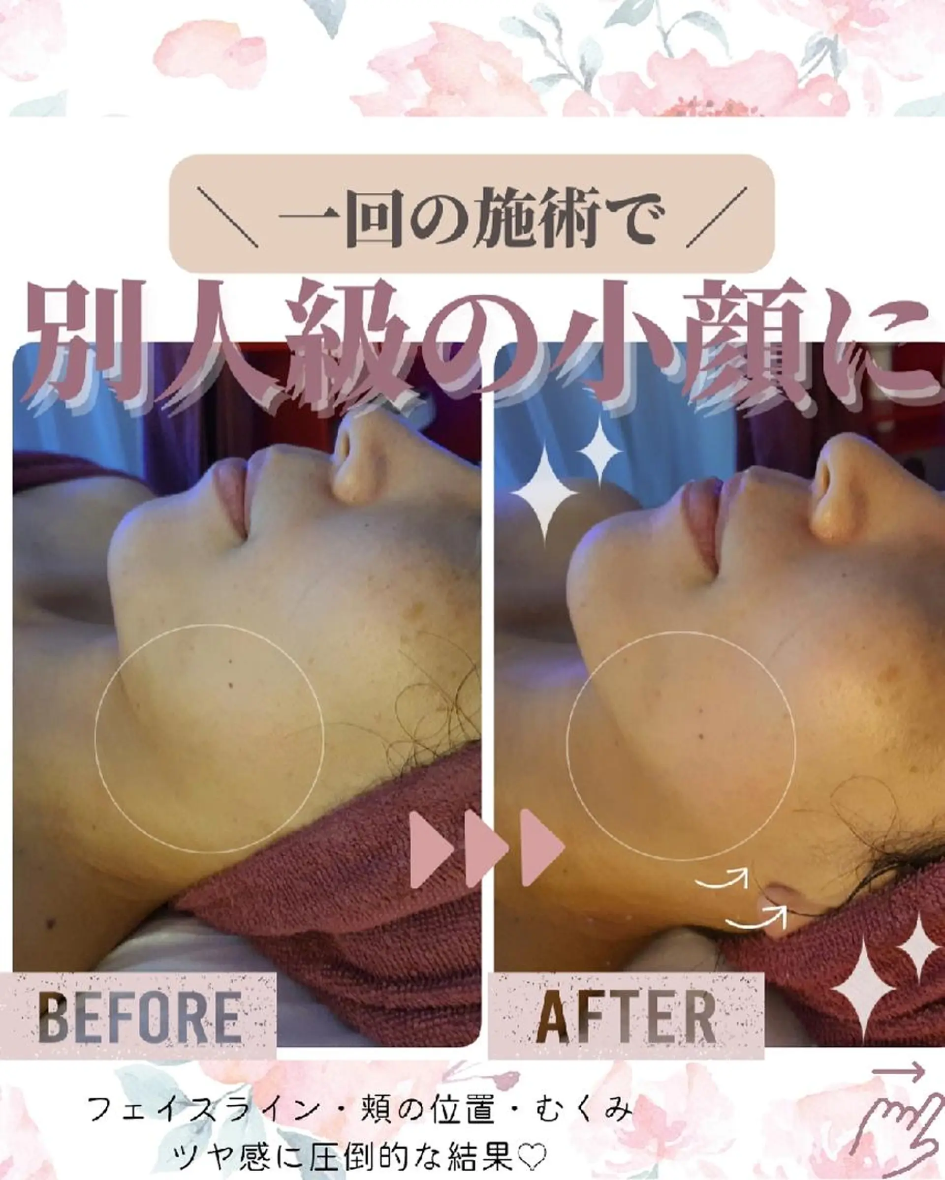 痩身ハーブピーリング 筋膜リリース☆B&Hのエステ・リラクイメージ