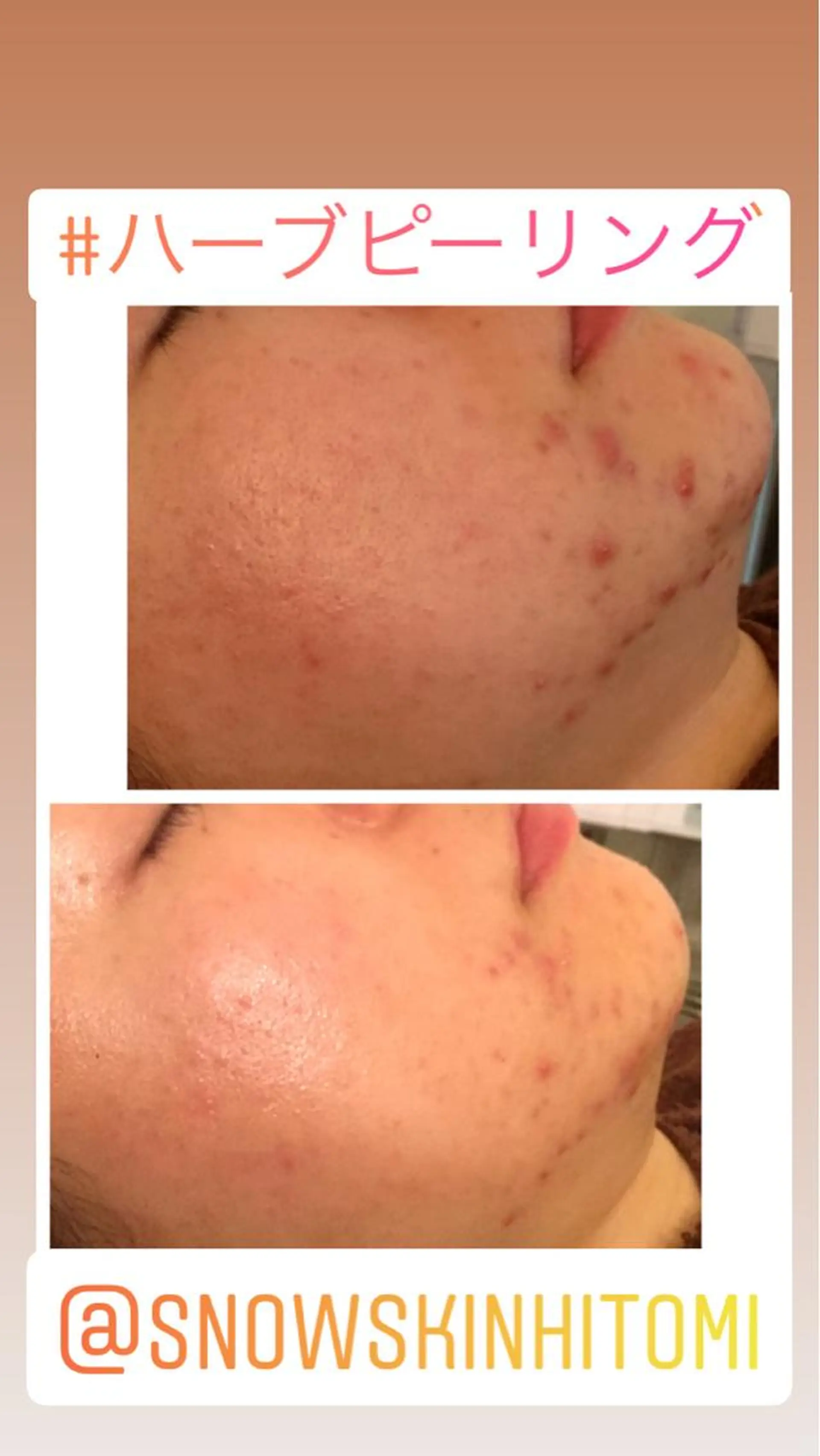 エステ リラク ニキビ/肌質改善専門 Snow skinのエステ・リラクイメージ