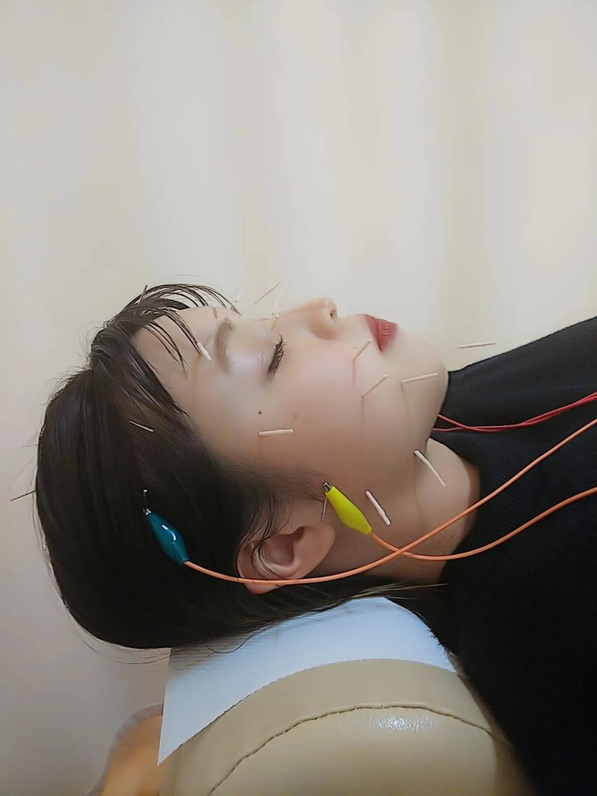 リフトアップ・たるみ ☆美容鍼小顔矯正のその他イメージ