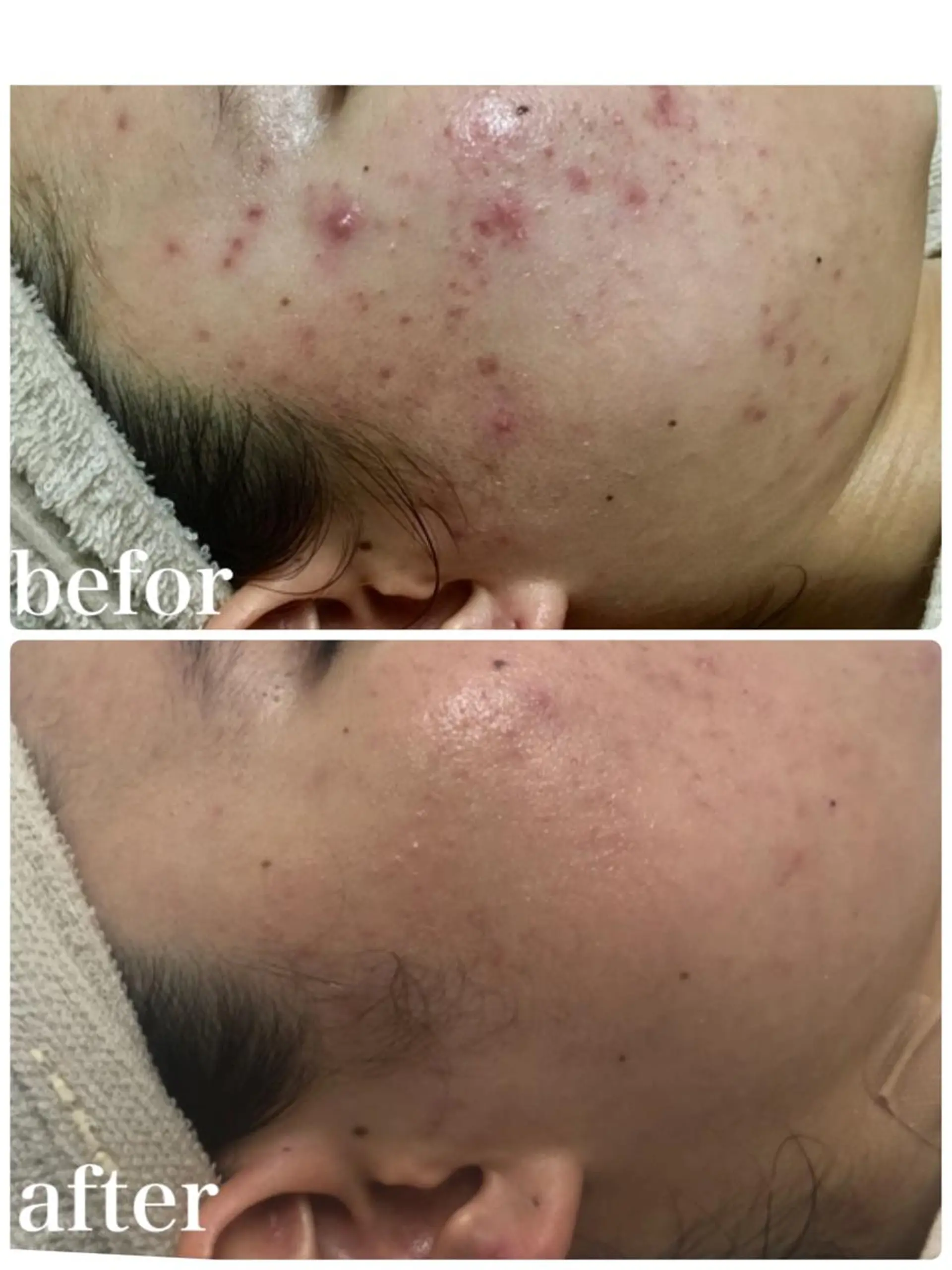 Meupニキビ専門店 背中/ハーブ/肌管理のその他イメージ