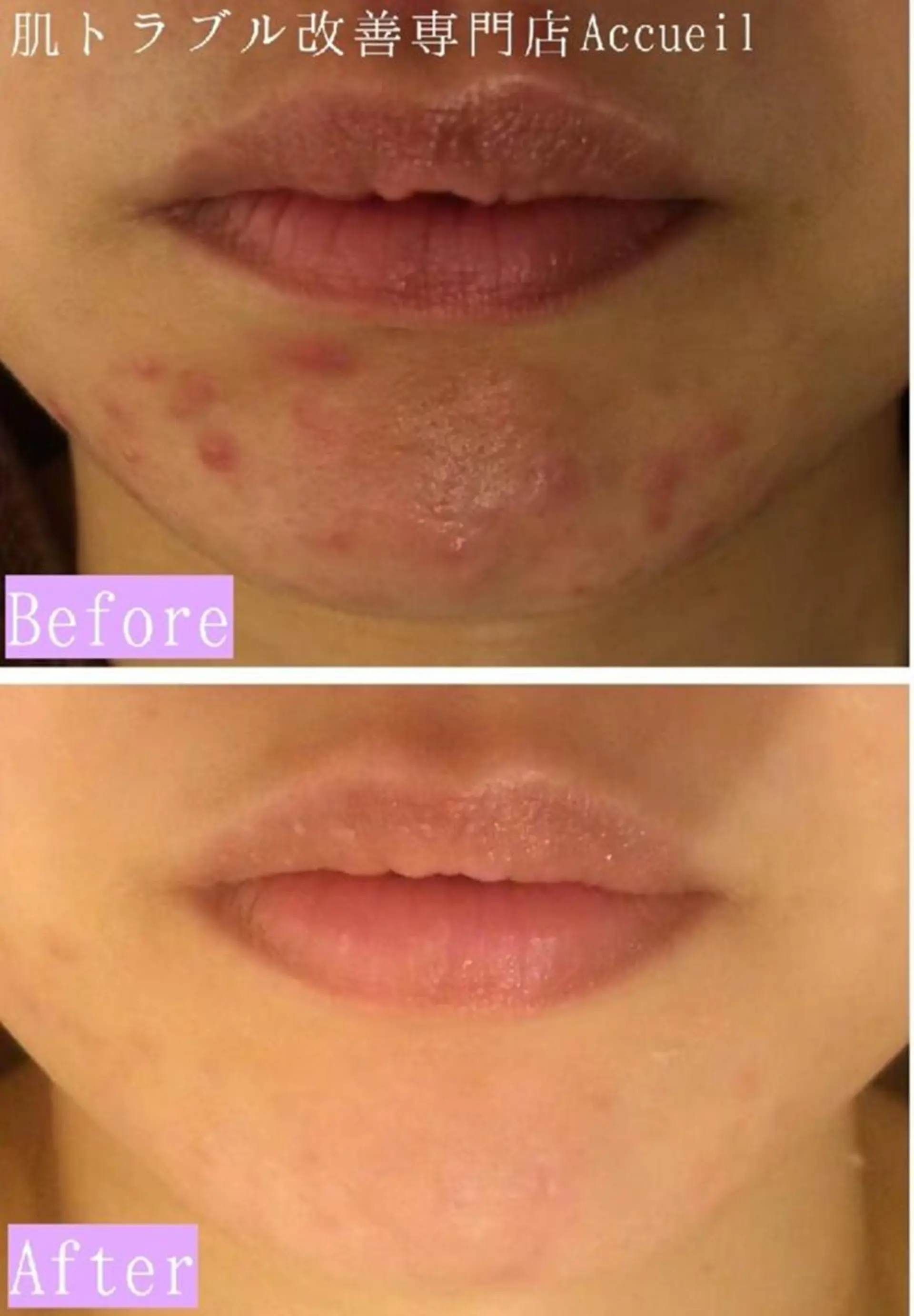 3か月で肌革命👼 ニキビ専門店💫のエステ・リラクイメージ