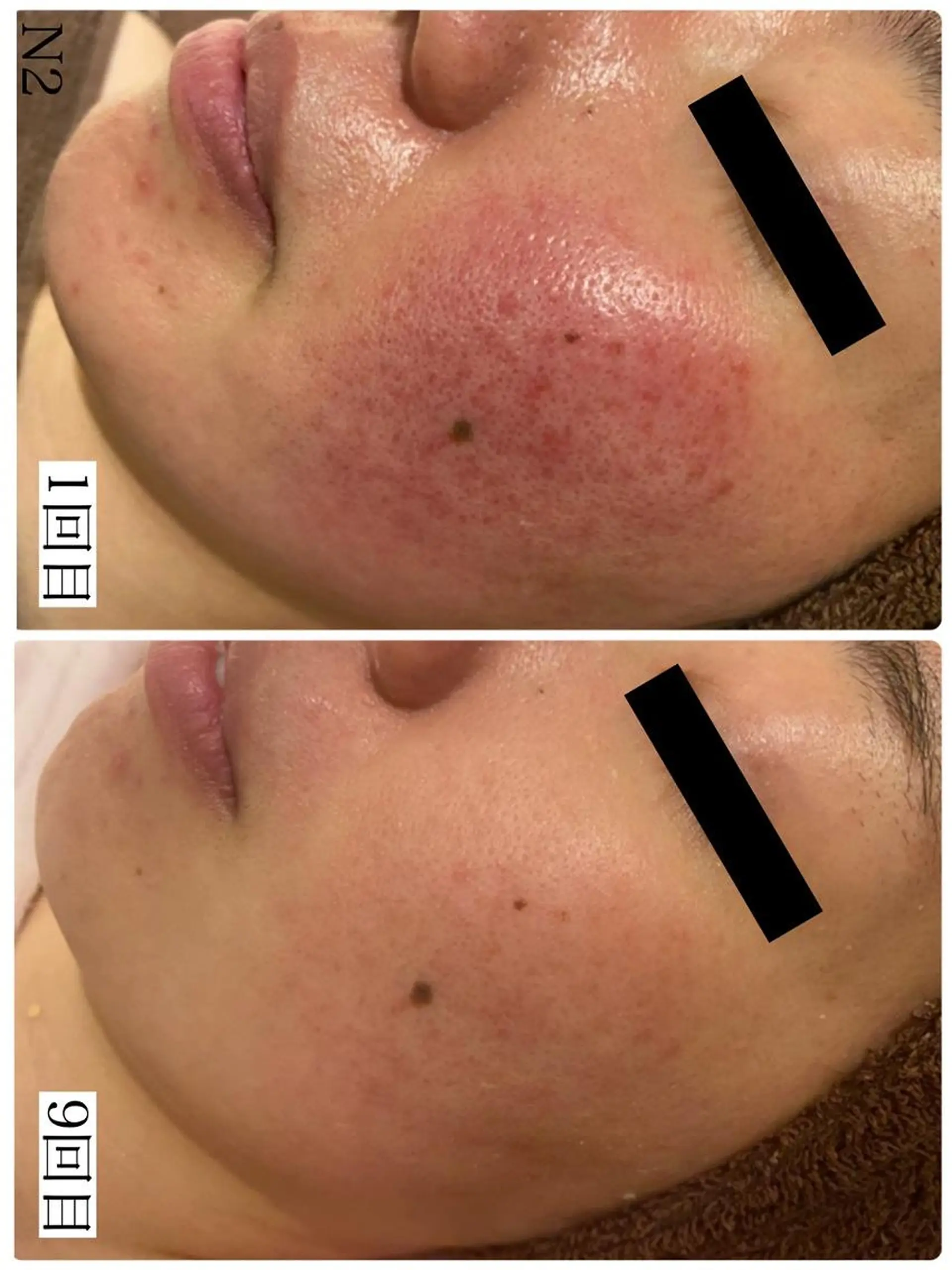 3か月で肌革命👼 ニキビ専門店💫のエステ・リラクイメージ