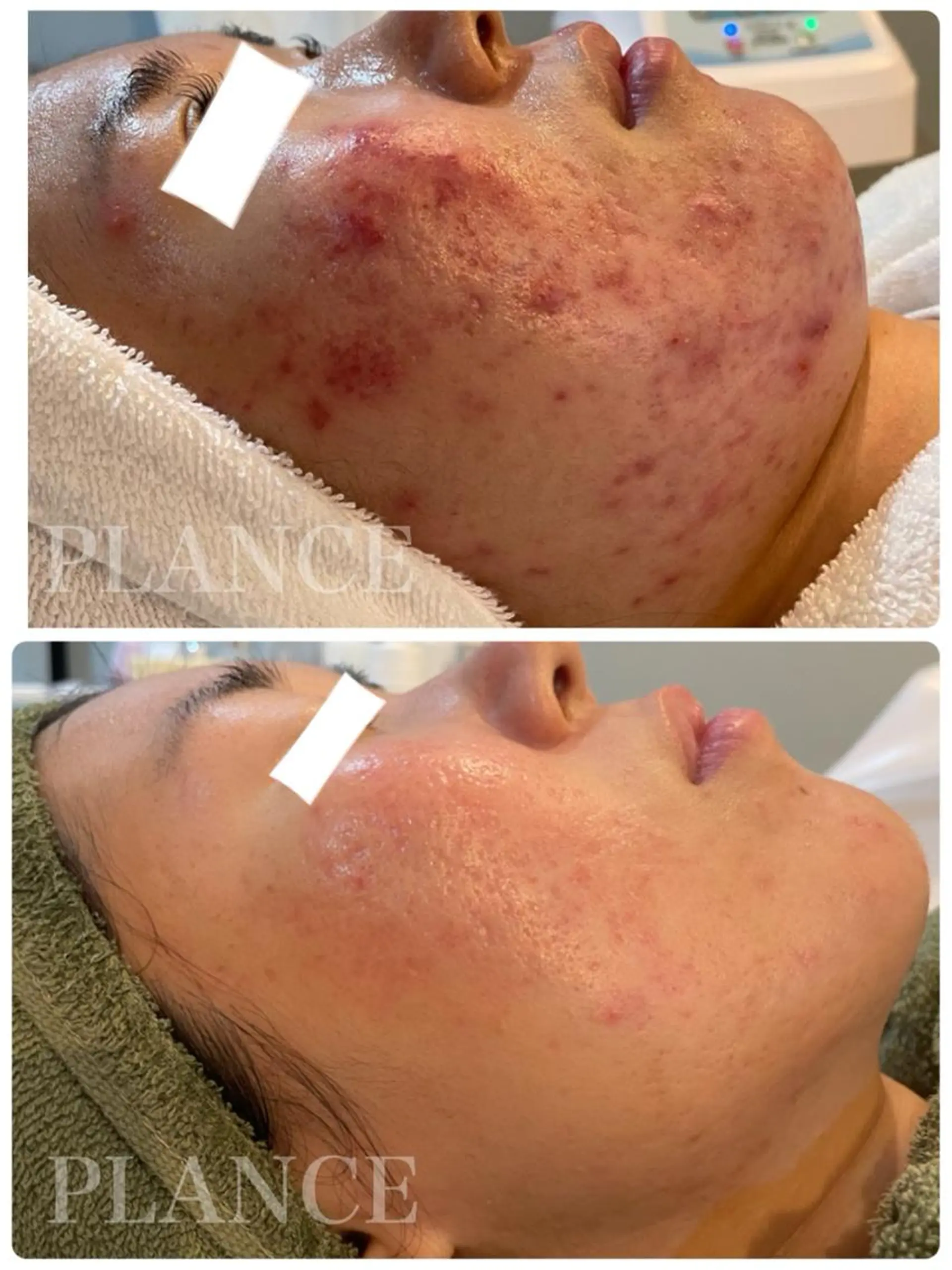 エステ フェイシャル専門 肌質改善/プランスのエステ・リラクイメージ