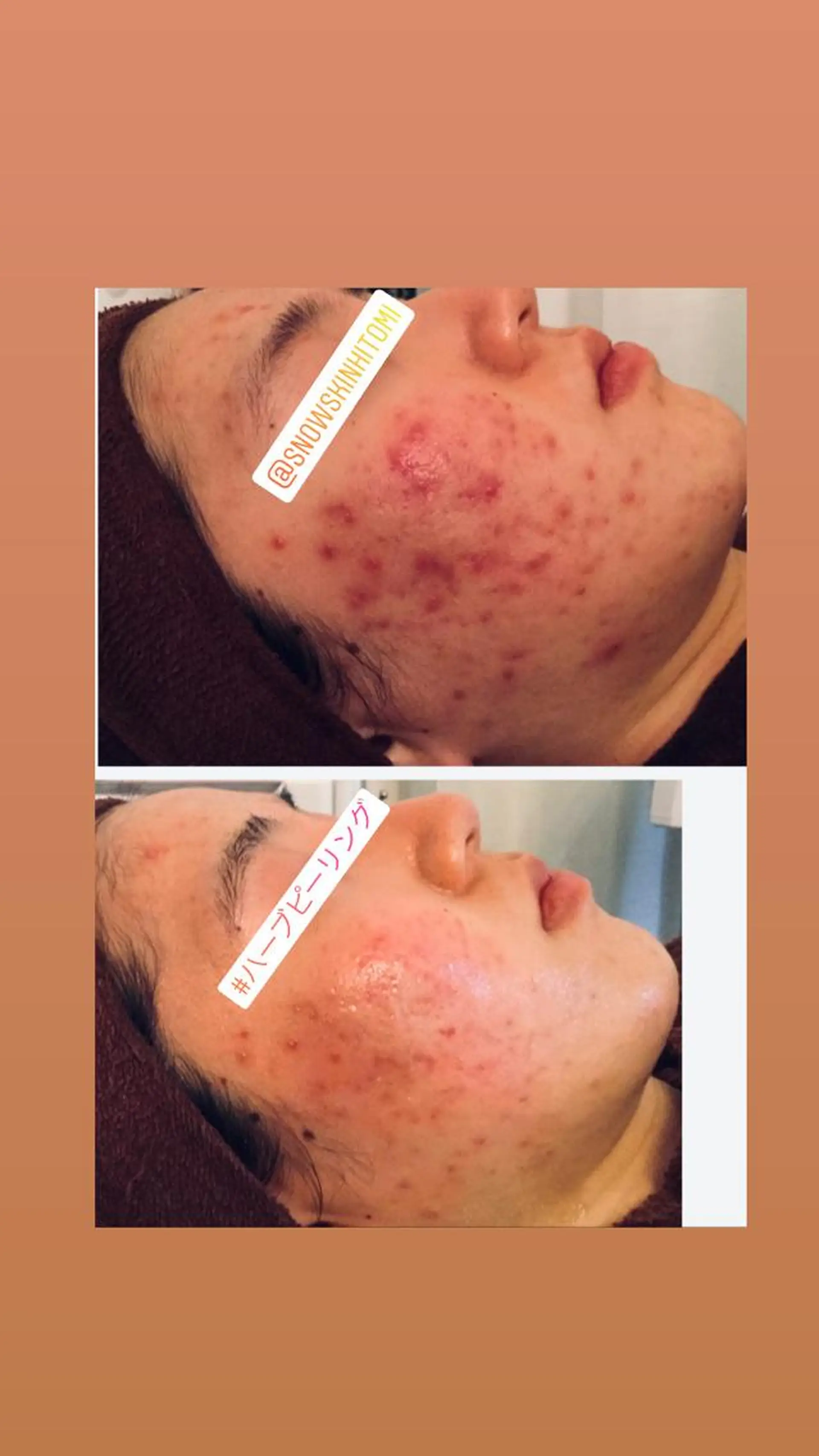 エステ リラク ニキビ/肌質改善専門 Snow skinのエステ・リラクイメージ