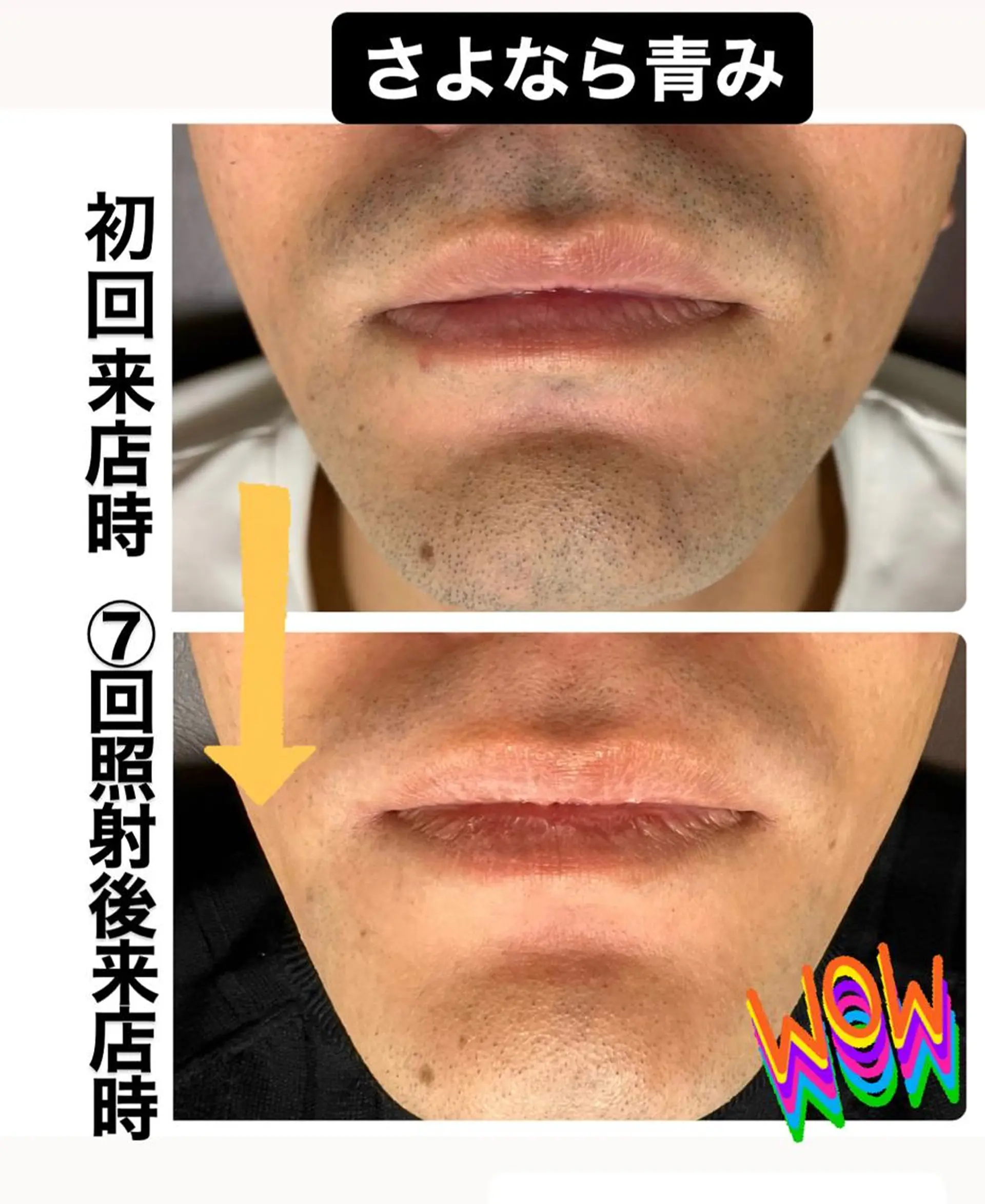 メンズ メンズハイライト 脱毛 メンズ脱毛サロン Le falcoのエステ・リラクイメージ