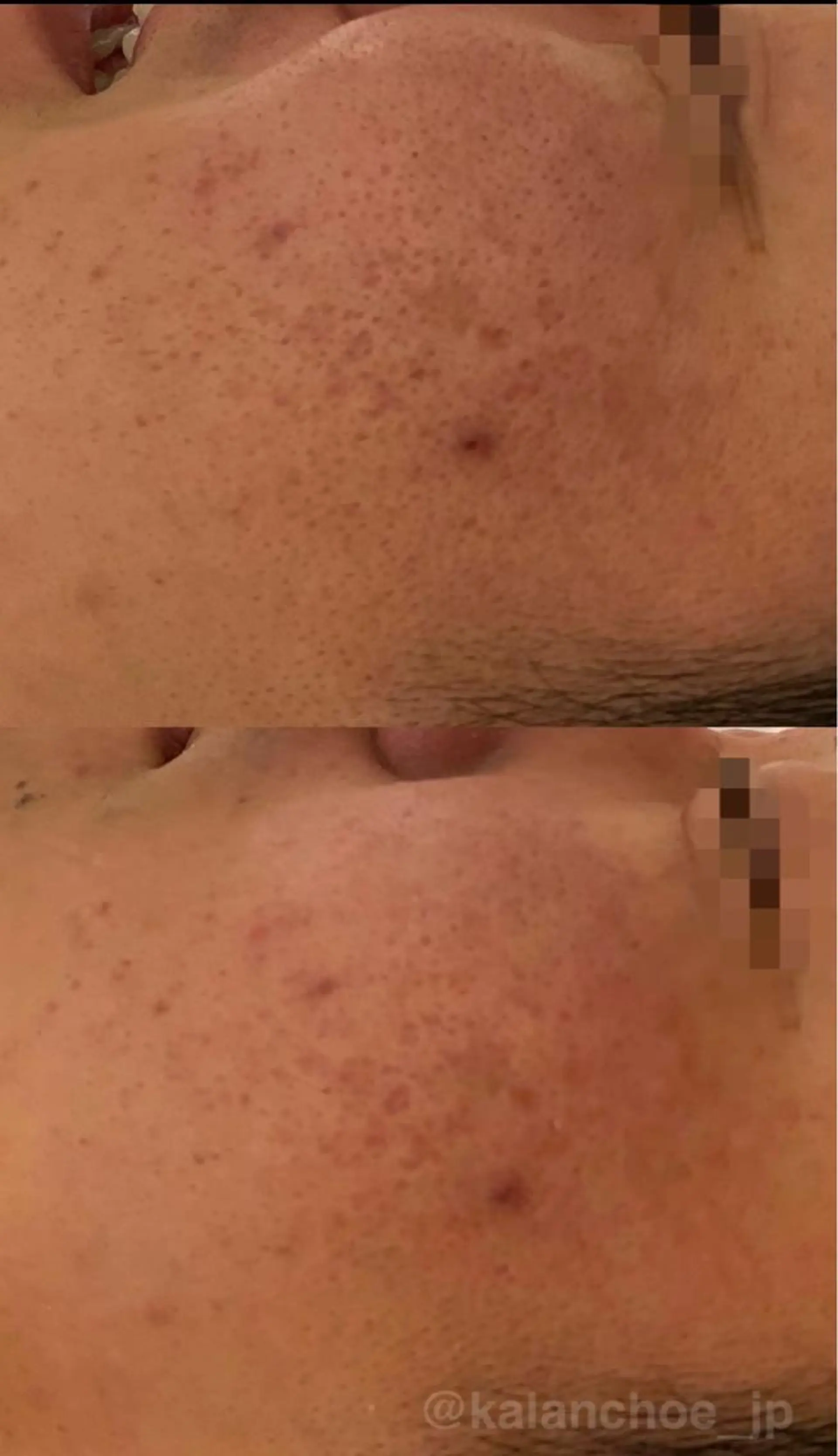 エステ 肌質改善 KALANCHOEのエステ・リラクイメージ