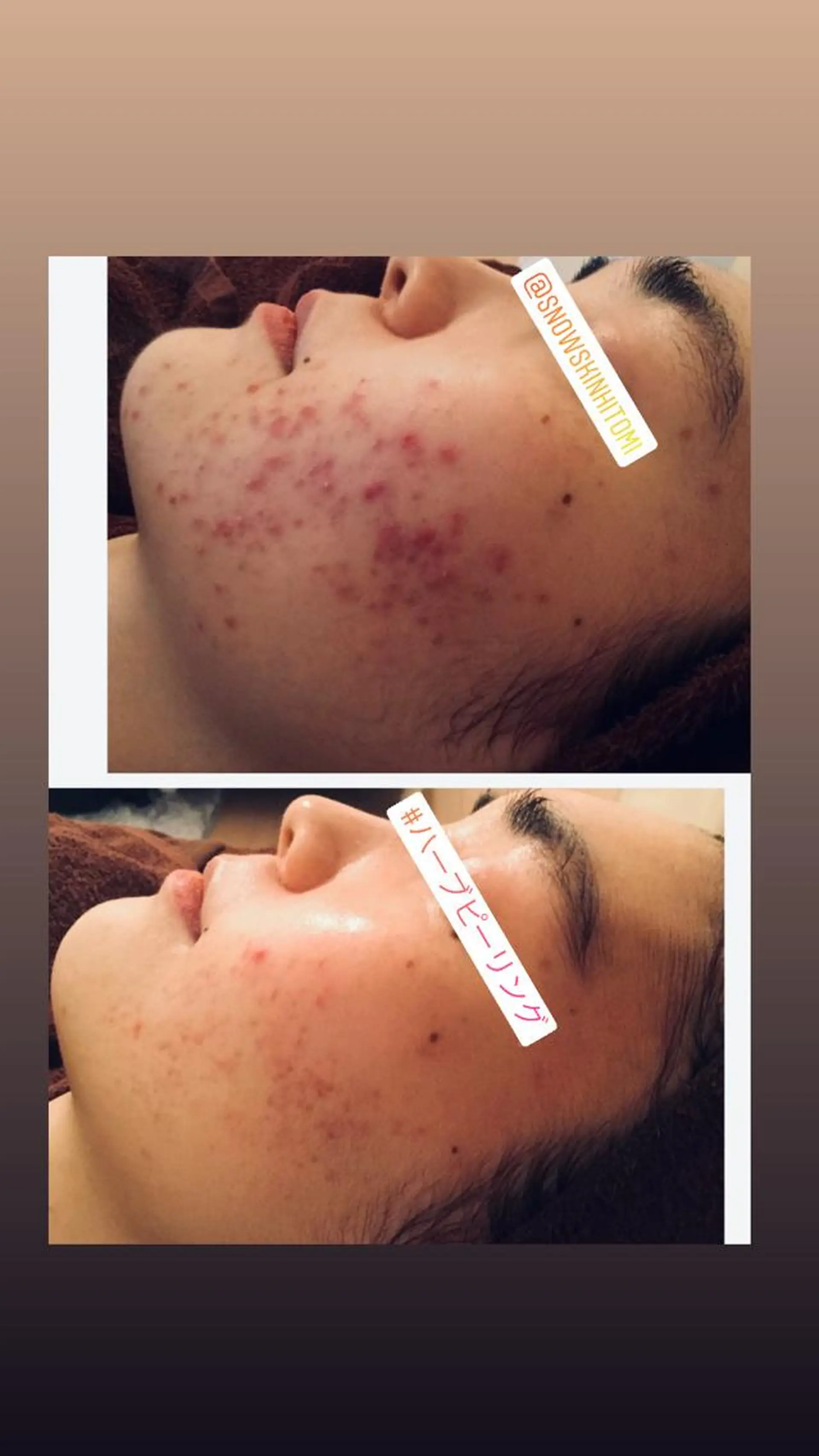 エステ リラク ニキビ/肌質改善専門 Snow skinのエステ・リラクイメージ