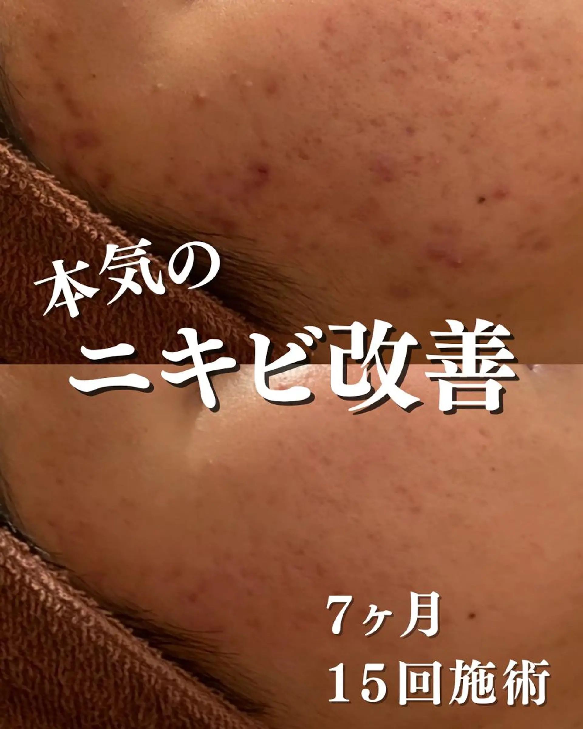 エステ リラク 3か月で肌革命👼 ニキビ専門店💫のエステ・リラクイメージ