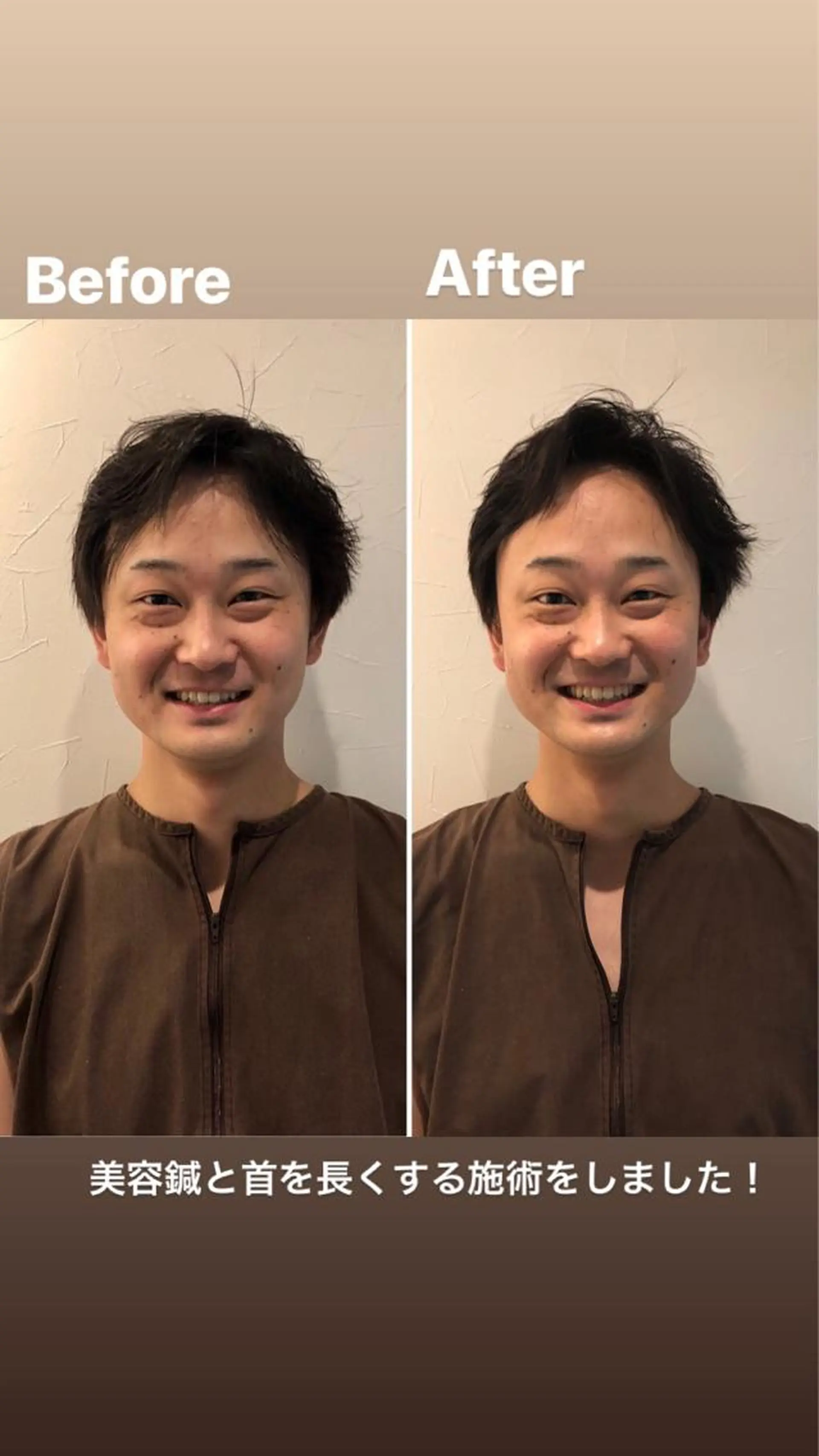 メンズ 即小顔♥️美容鍼× ハーブピーリングのその他イメージ