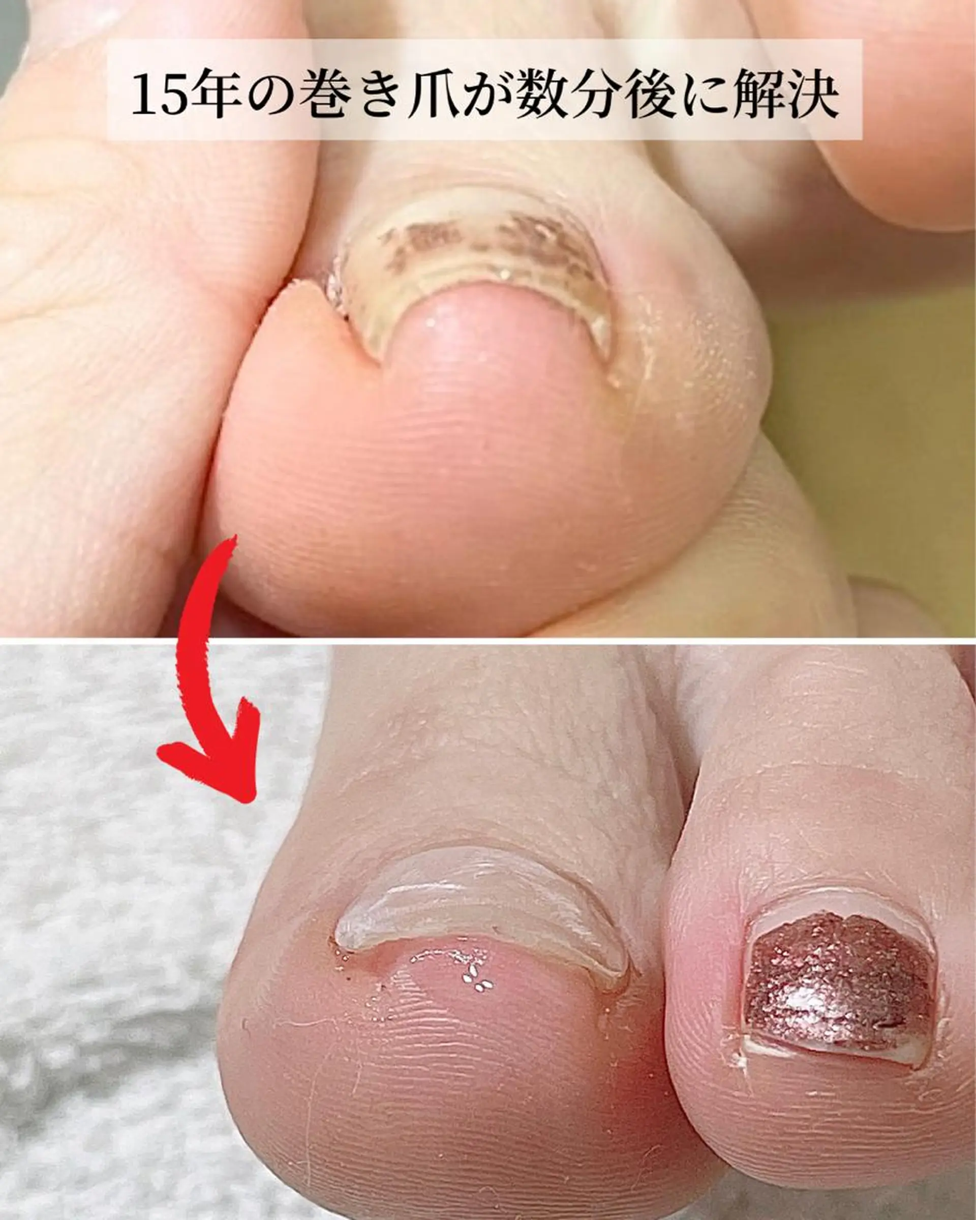 ネイル 深爪・巻き爪 専門サンセリテのネイルデザイン