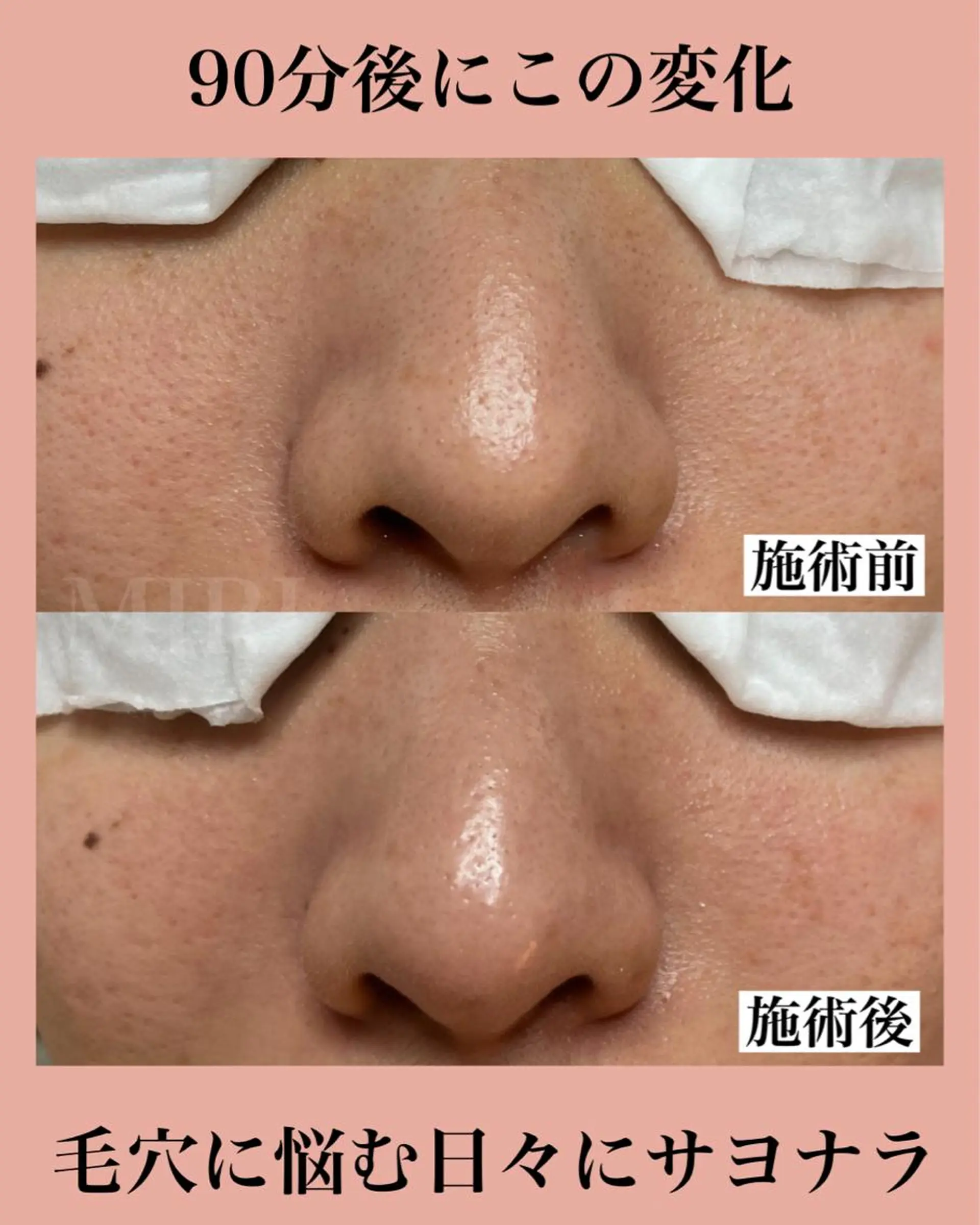 エステ 北堀江/毛穴改善専門 ミリのエステ・リラクイメージ