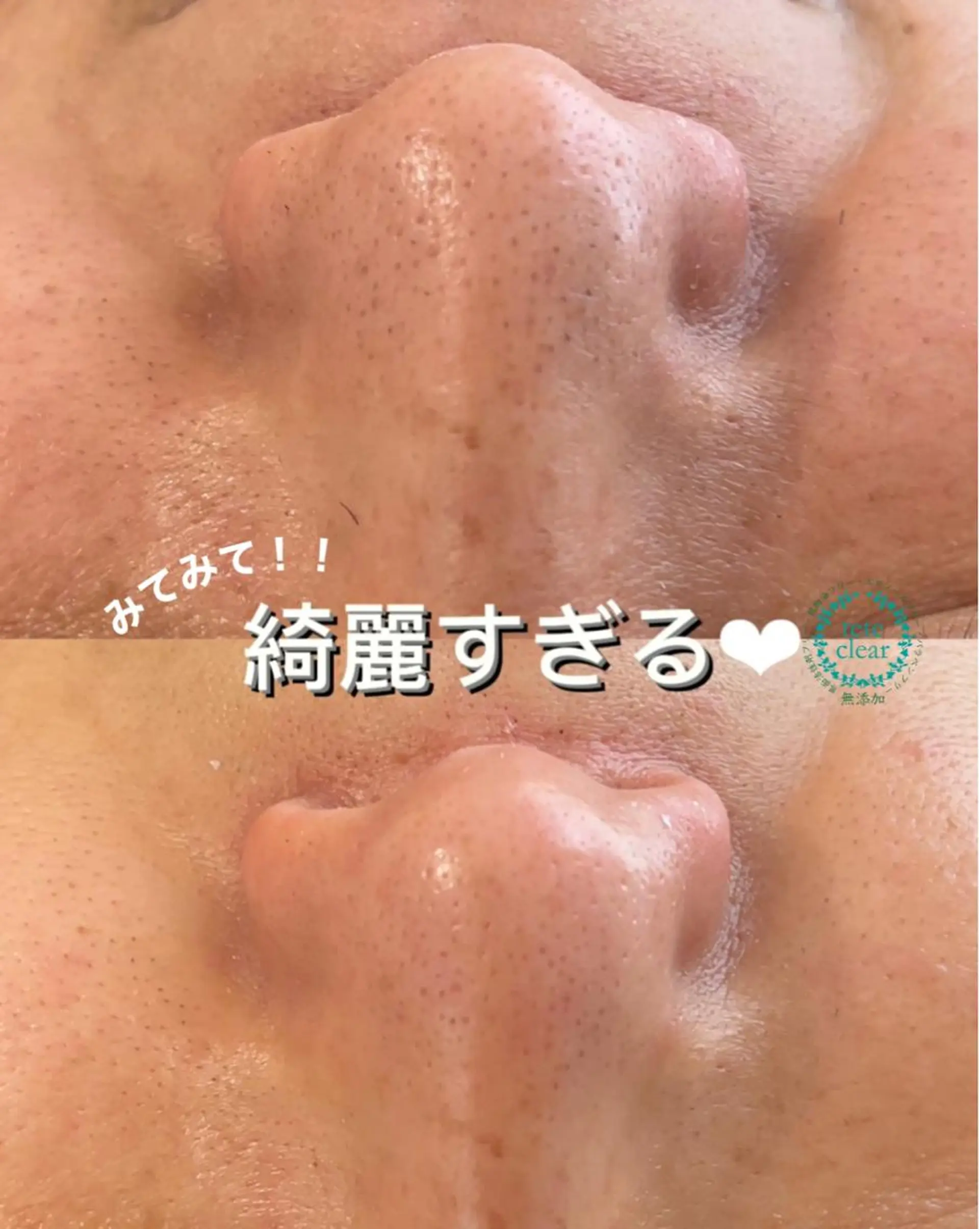 毛穴/シミ肝斑/脱毛 横山梨里のエステ・リラクイメージ