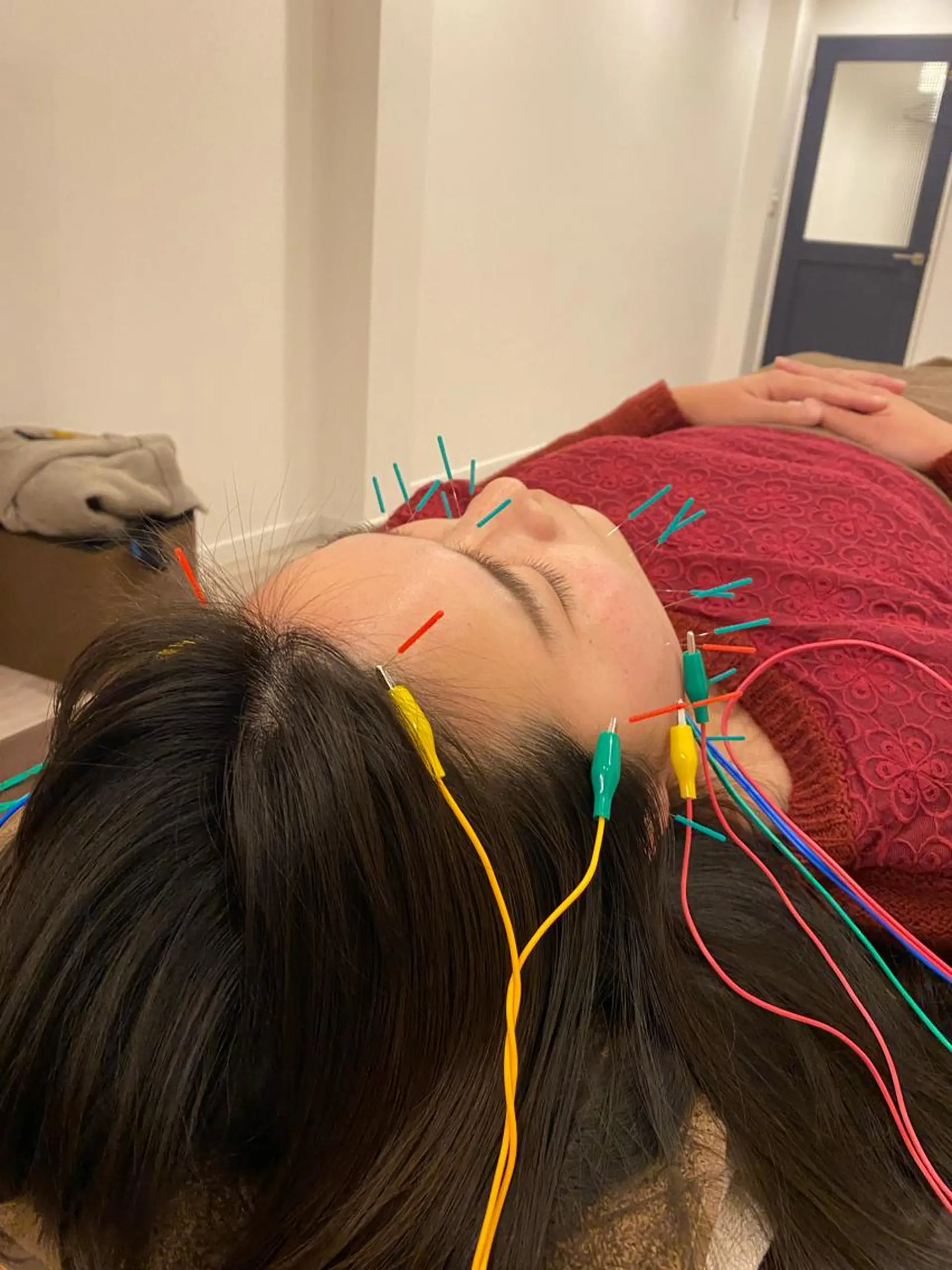 エステ リラク 肌質改善×美容鍼 ゆいのエステ・リラクイメージ