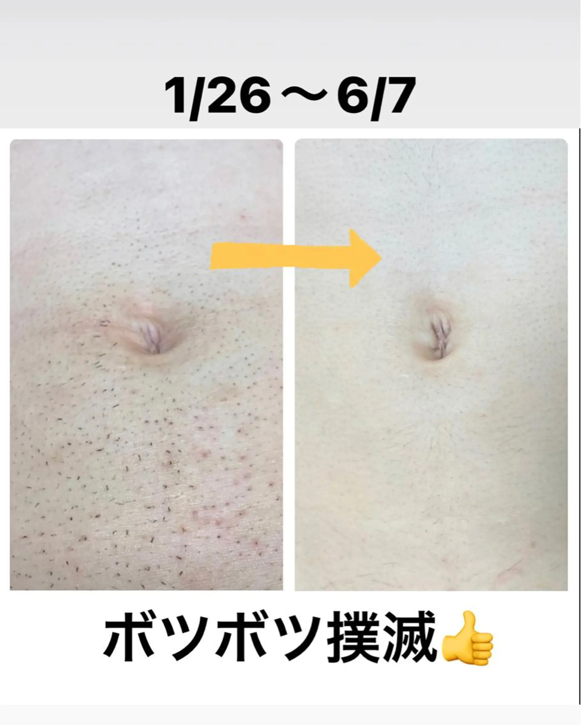 メンズ メンズハイライト 脱毛 メンズ脱毛サロン Le falcoのエステ・リラクイメージ