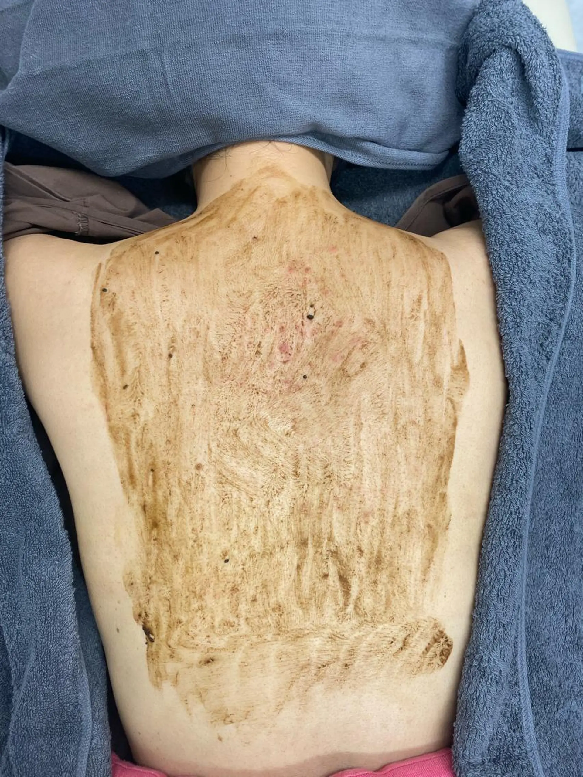 ニキビ特化美容鍼 ×ハーブピーリングのエステ・リラクイメージ