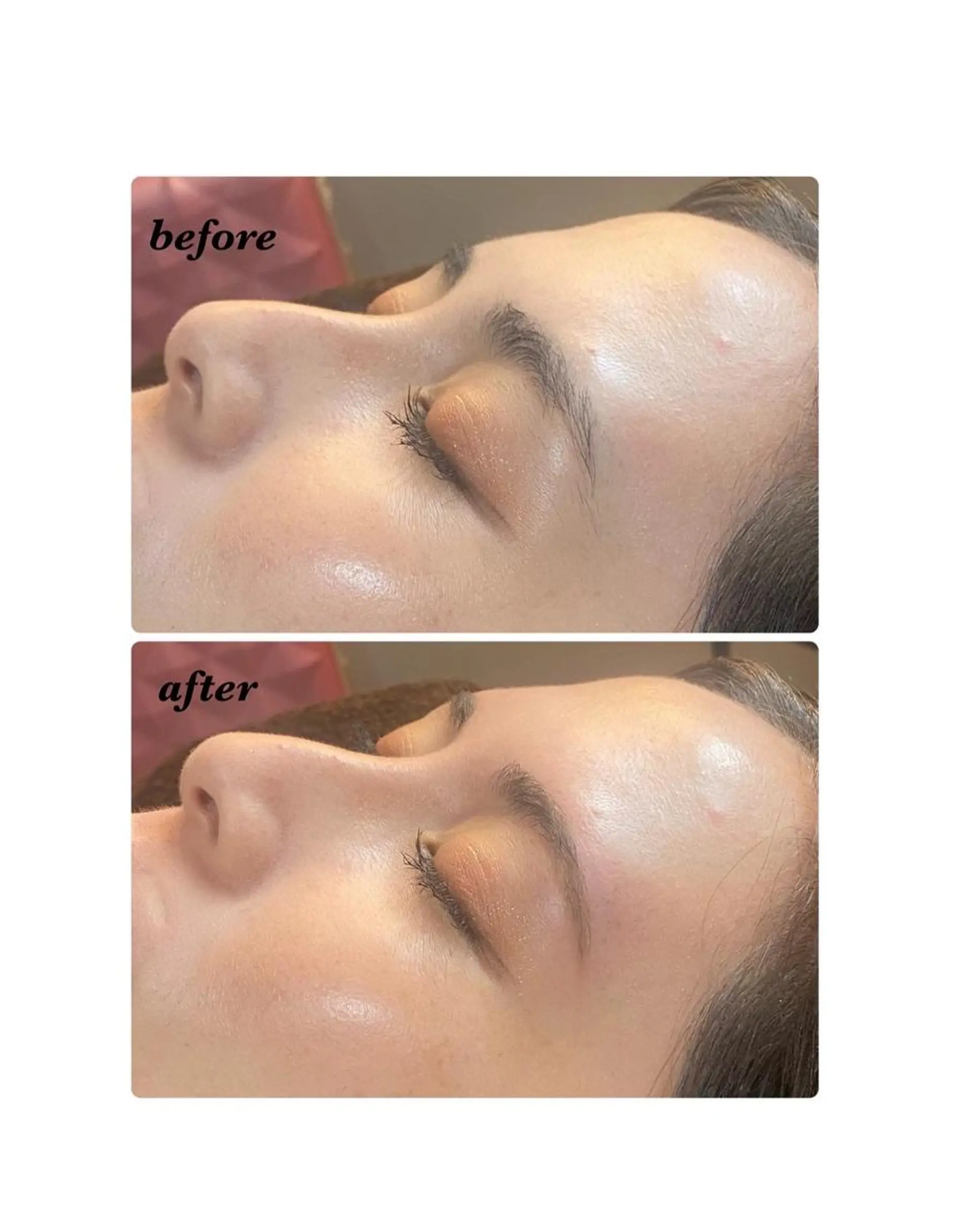 アイブロウ ハーブピーリング/韓国肌管理/フェイシャル/毛穴洗浄/眉毛/顔脱毛【糸脱毛専門】rev所属・ハーブピーリング専門 毛穴洗浄❤️眉waxのエステ・リラクイメージ