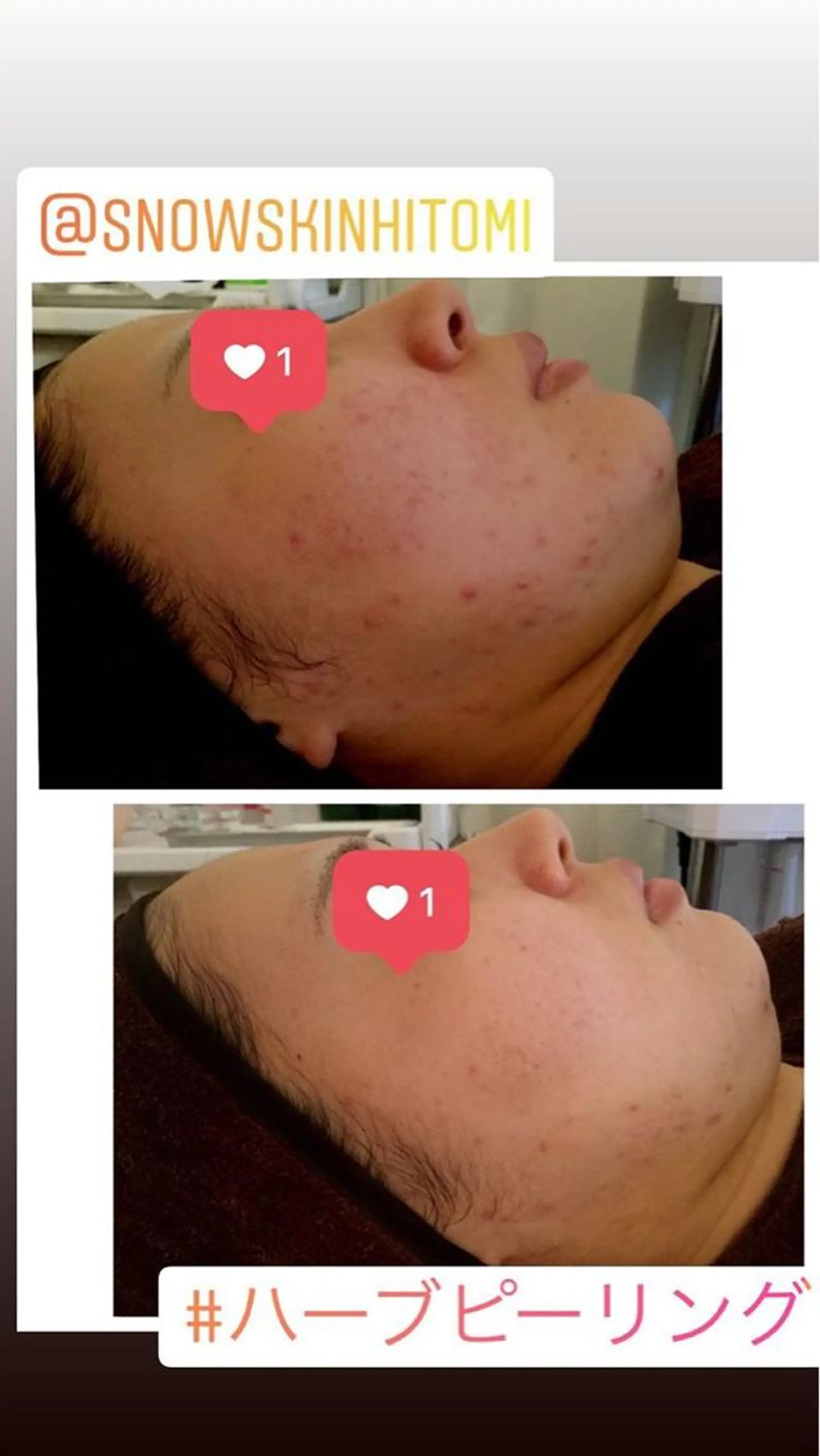 ニキビ/肌質改善専門 Snow skinのエステ・リラクイメージ