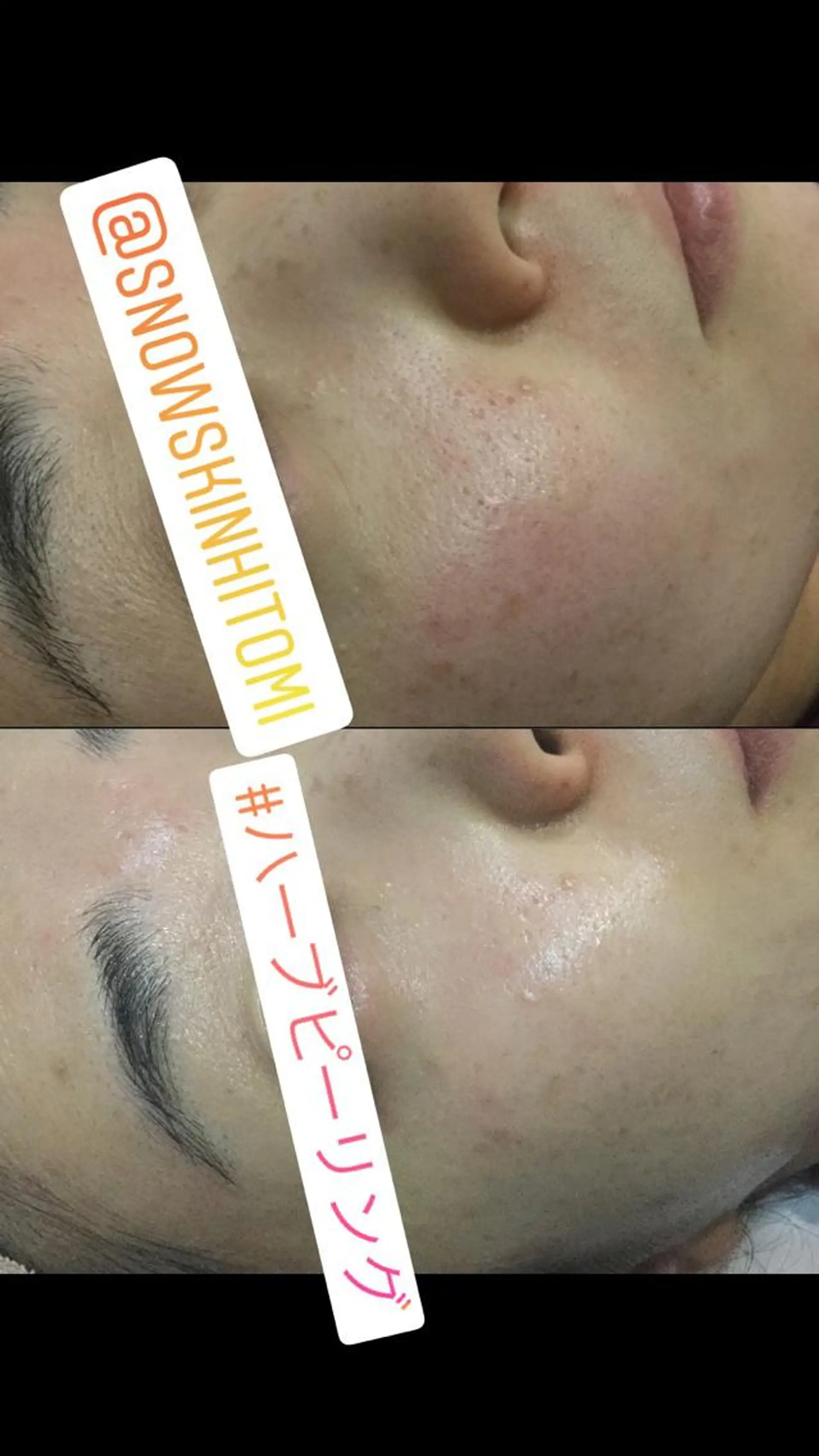 エステ リラク ニキビ/肌質改善専門 Snow skinのエステ・リラクイメージ