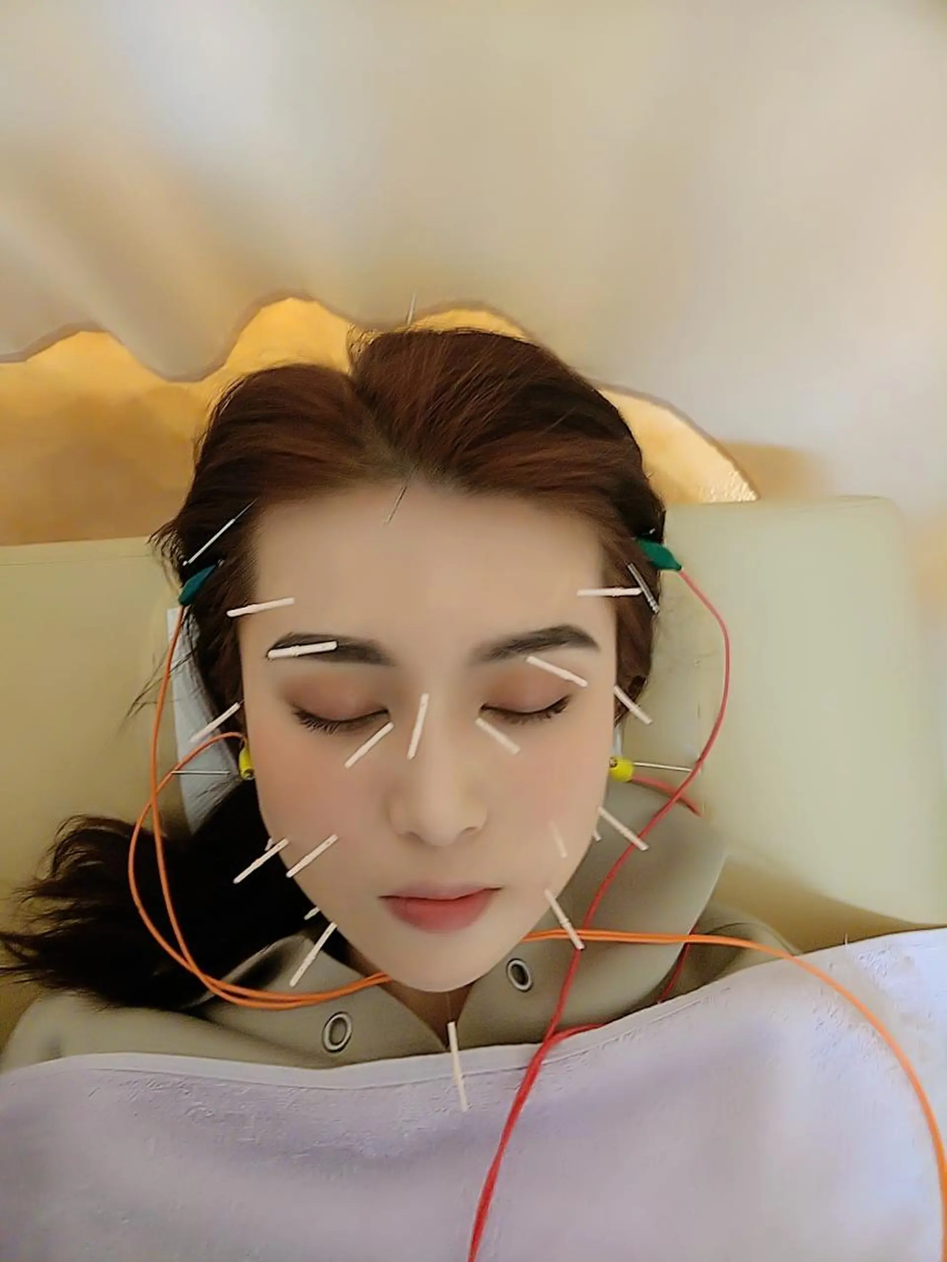 リフトアップ・たるみ ☆美容鍼小顔矯正のその他イメージ