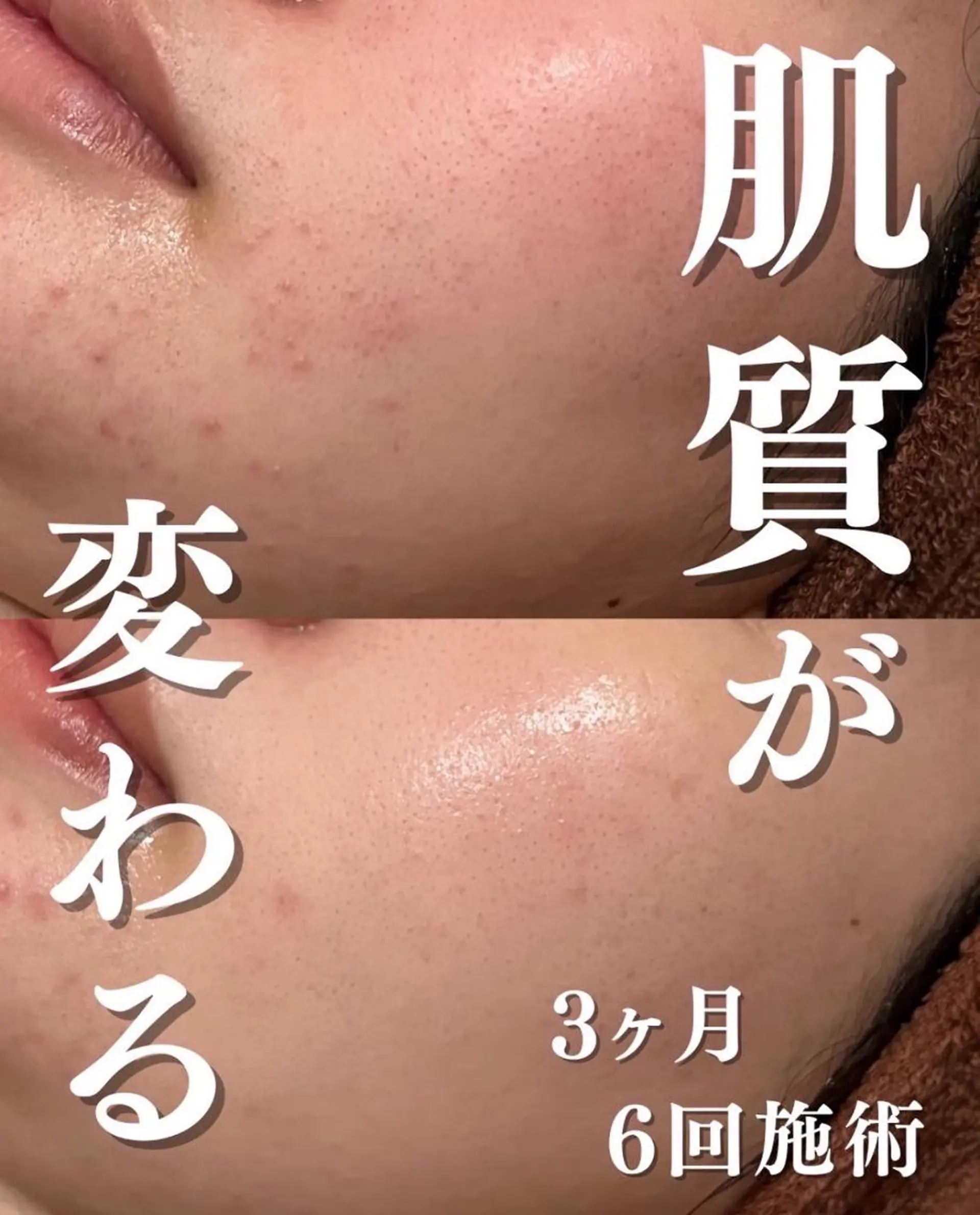 3か月で肌革命👼 ニキビ専門店💫のエステ・リラクイメージ