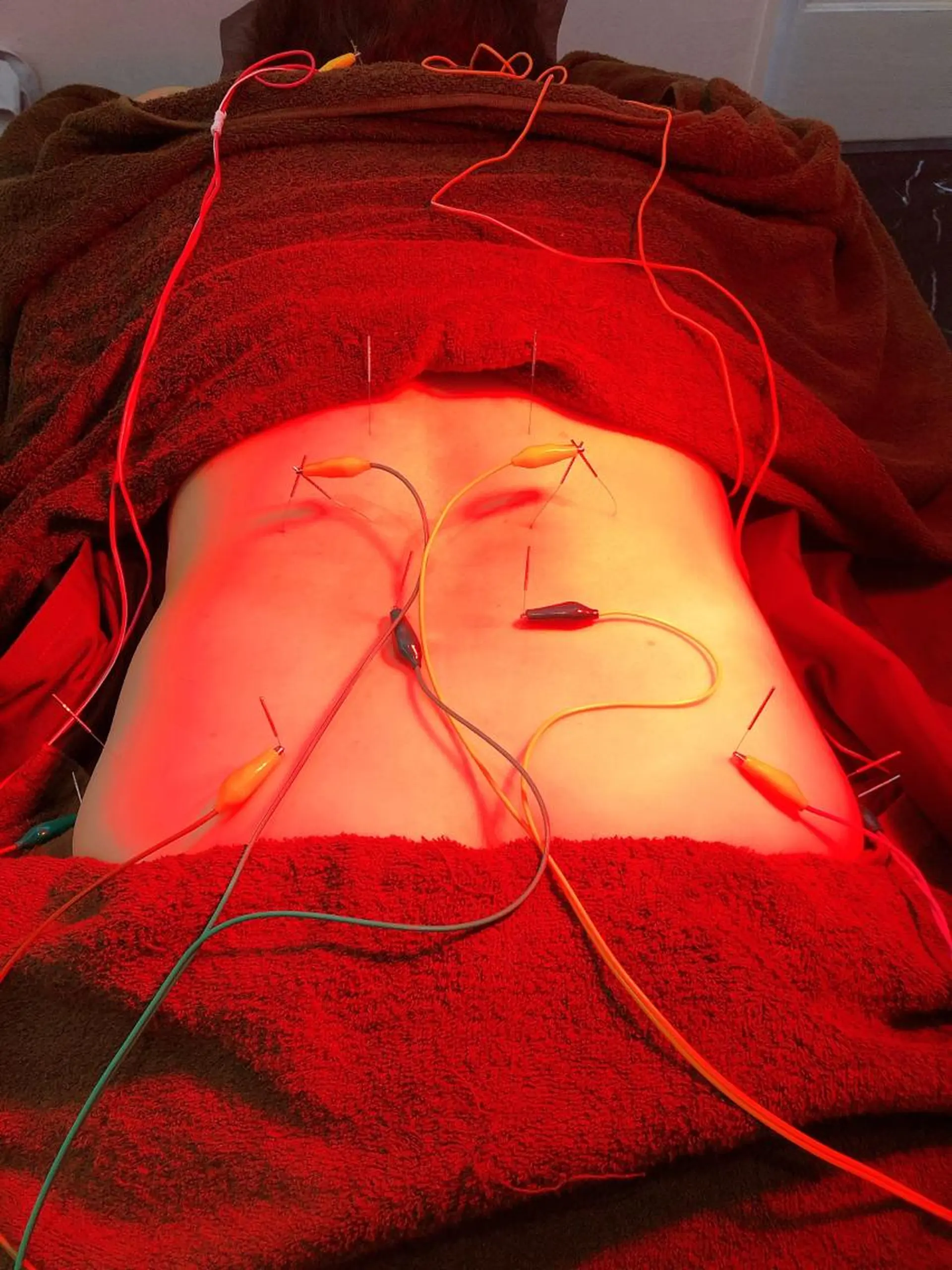 その他 小顔矯/美容鍼/鍼灸 BeauJuのその他イメージ