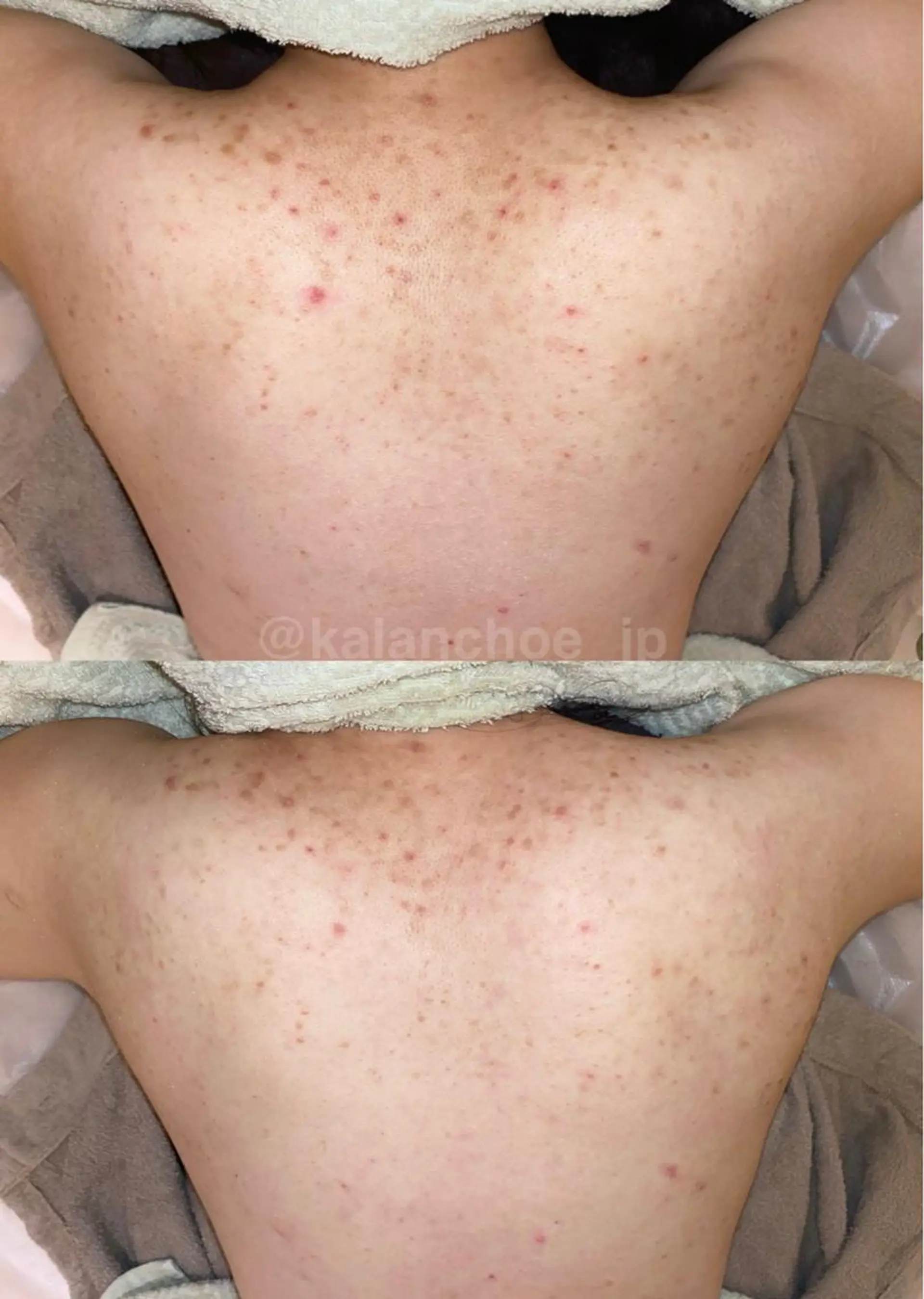 肌質改善 KALANCHOEのエステ・リラクイメージ