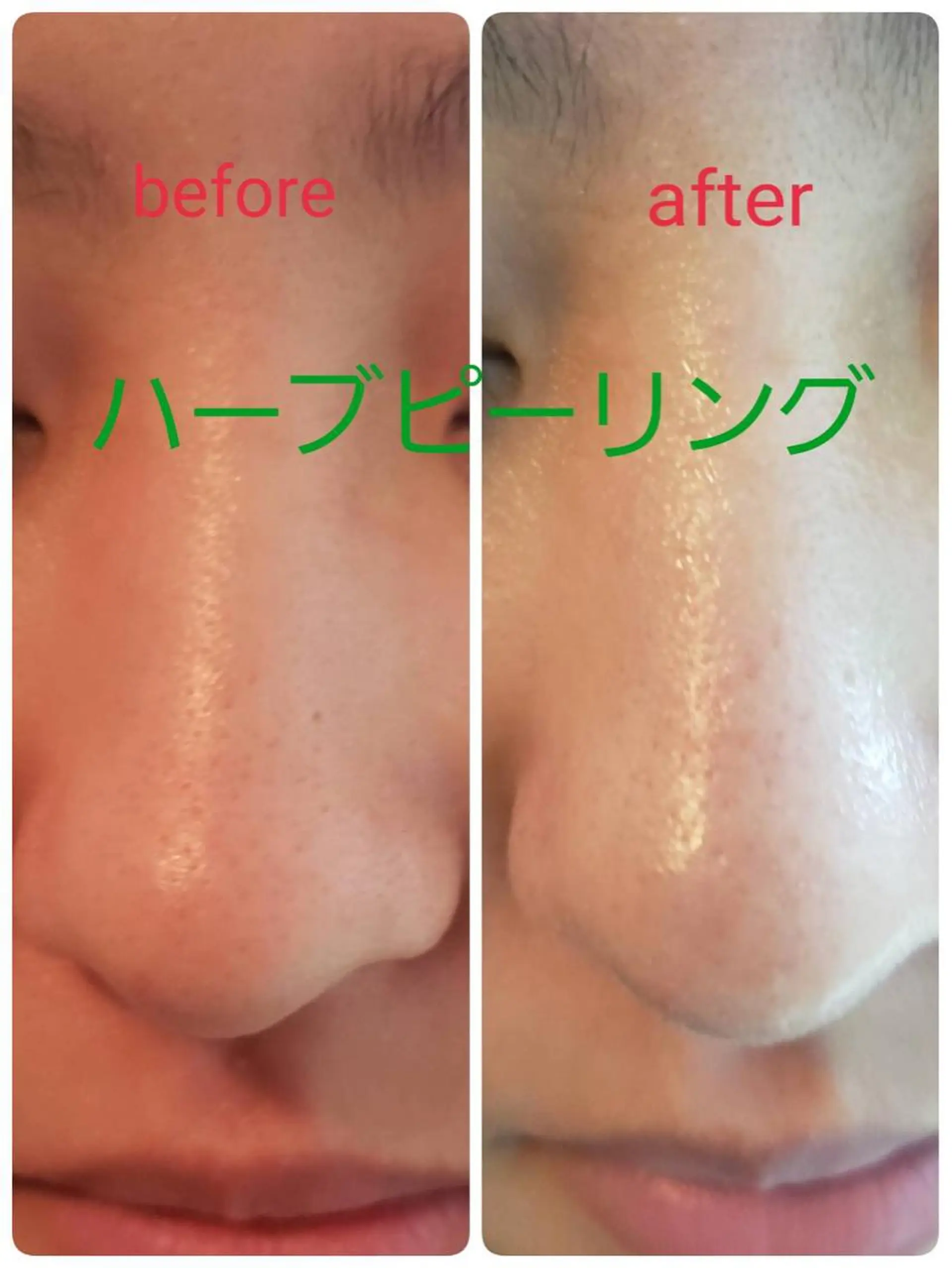 エステ 【リベルハーブピーリング認定店】敏感肌・美白脱毛専門店Dione立川店所属・Dione 立川店のエステ・リラクイメージ