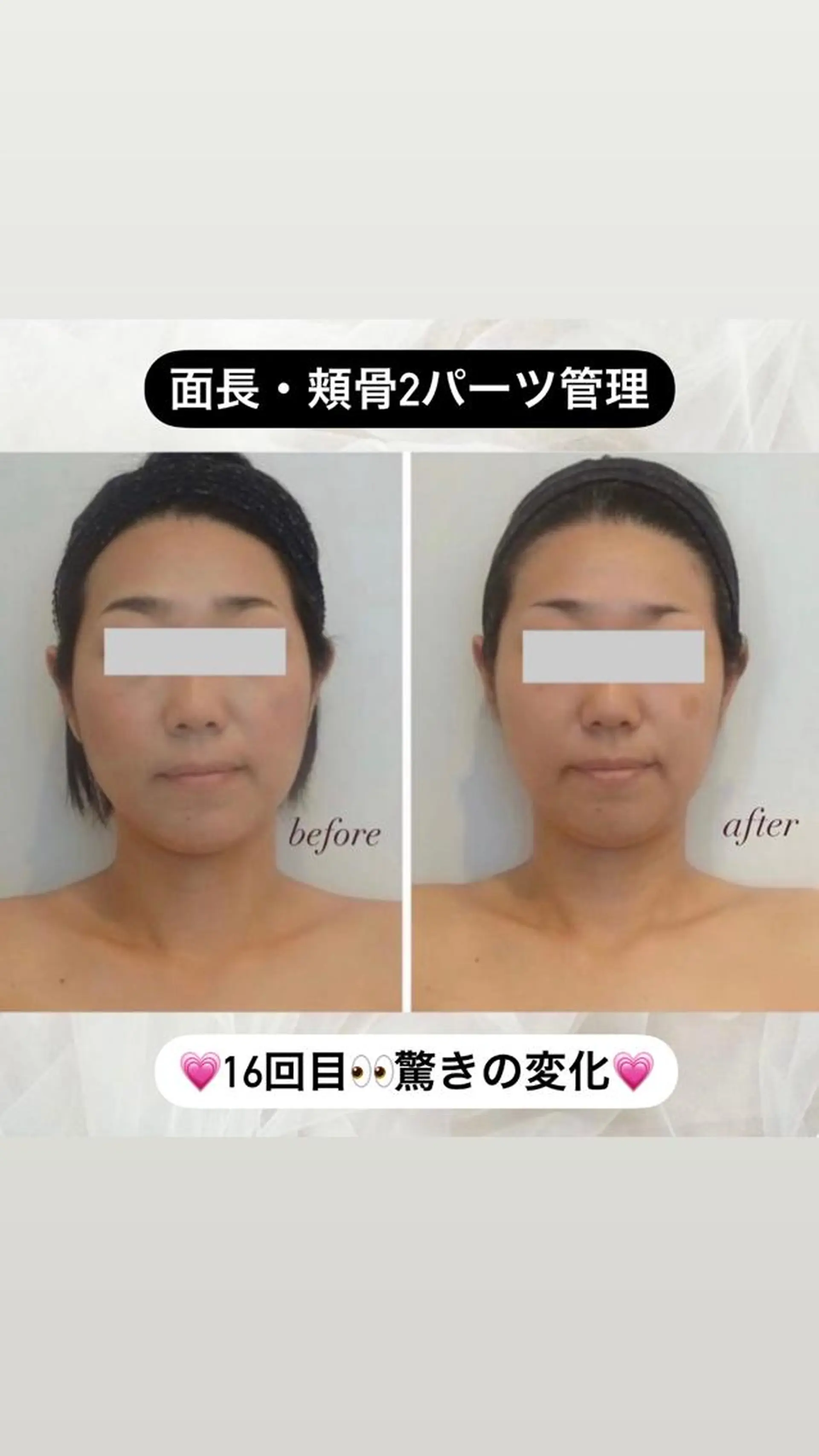 エステ リラク 整形級の変化👀 最新✨韓国小顔管理のエステ・リラクイメージ