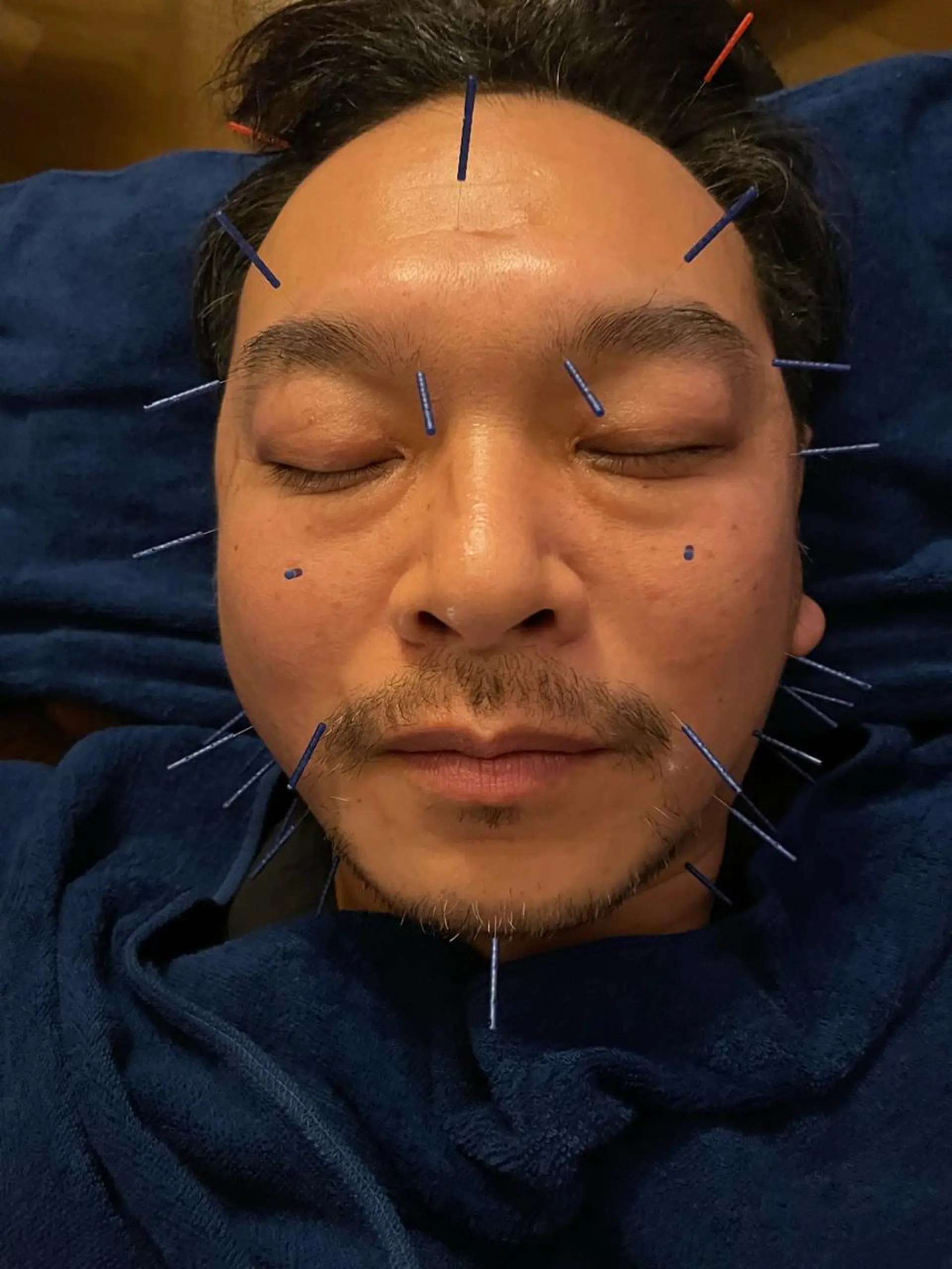 美楽鍼 びらくしんのその他イメージ