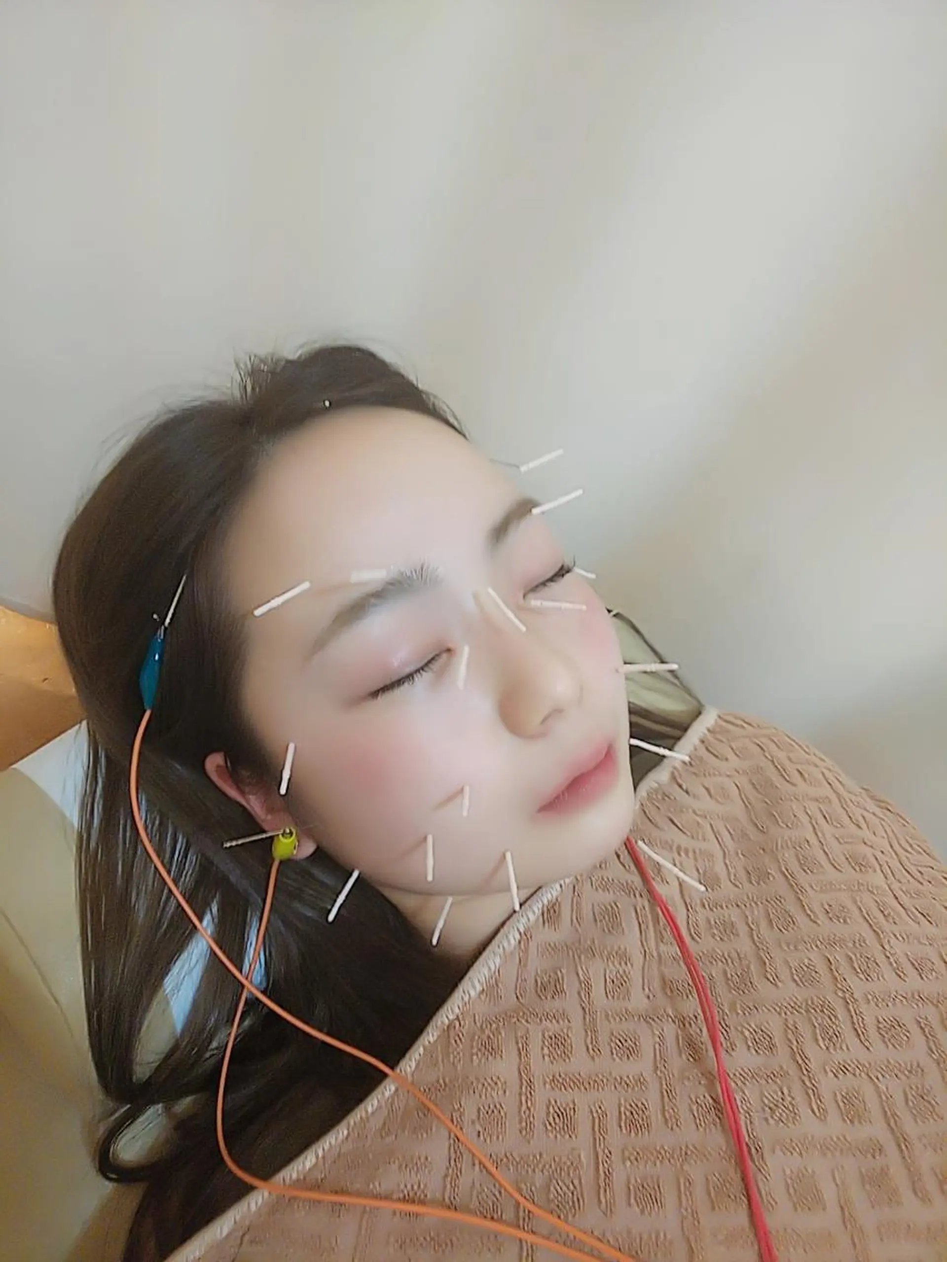 リフトアップ・たるみ ☆美容鍼小顔矯正のその他イメージ