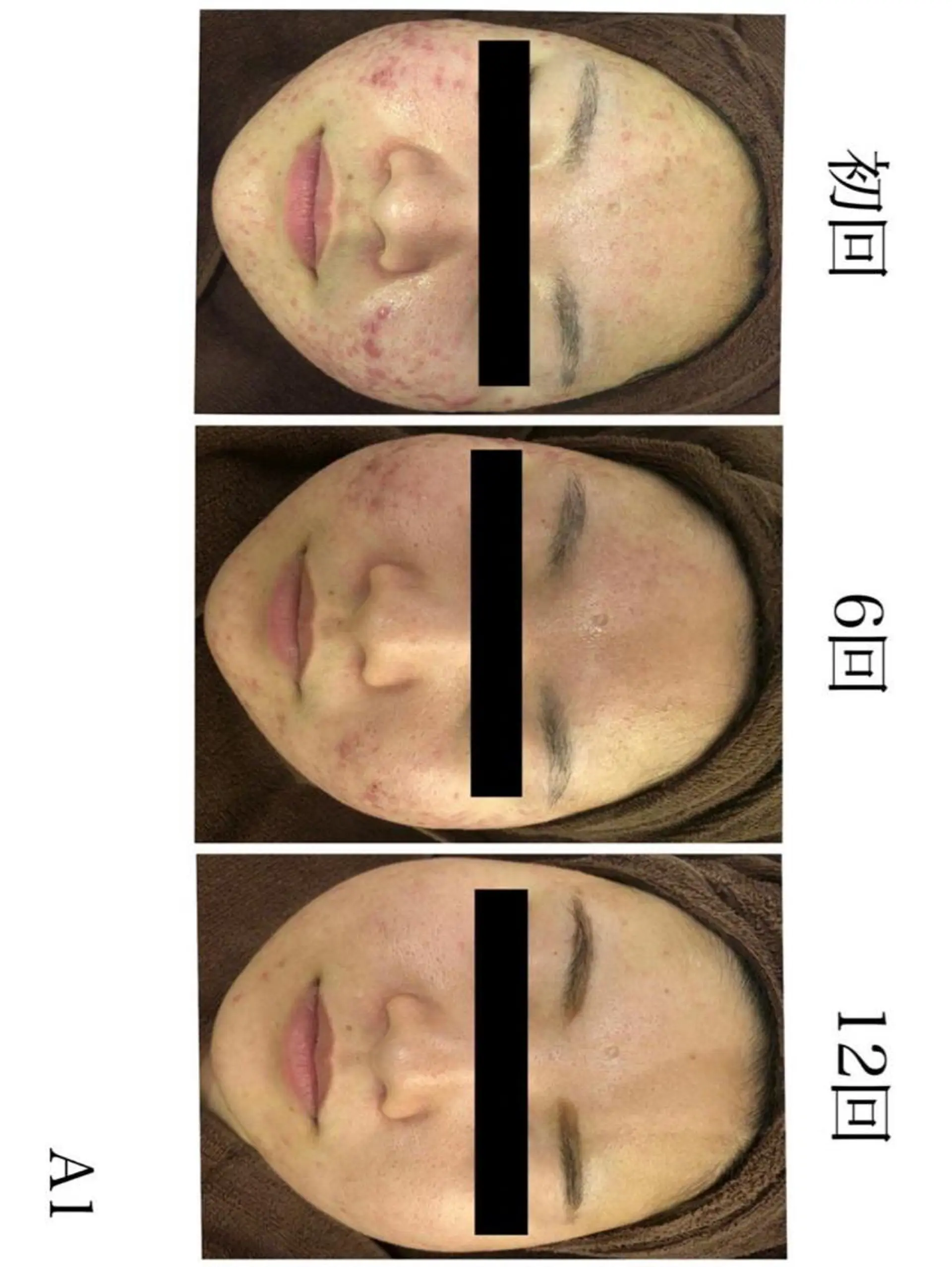 3か月で肌革命👼 ニキビ専門店💫のエステ・リラクイメージ