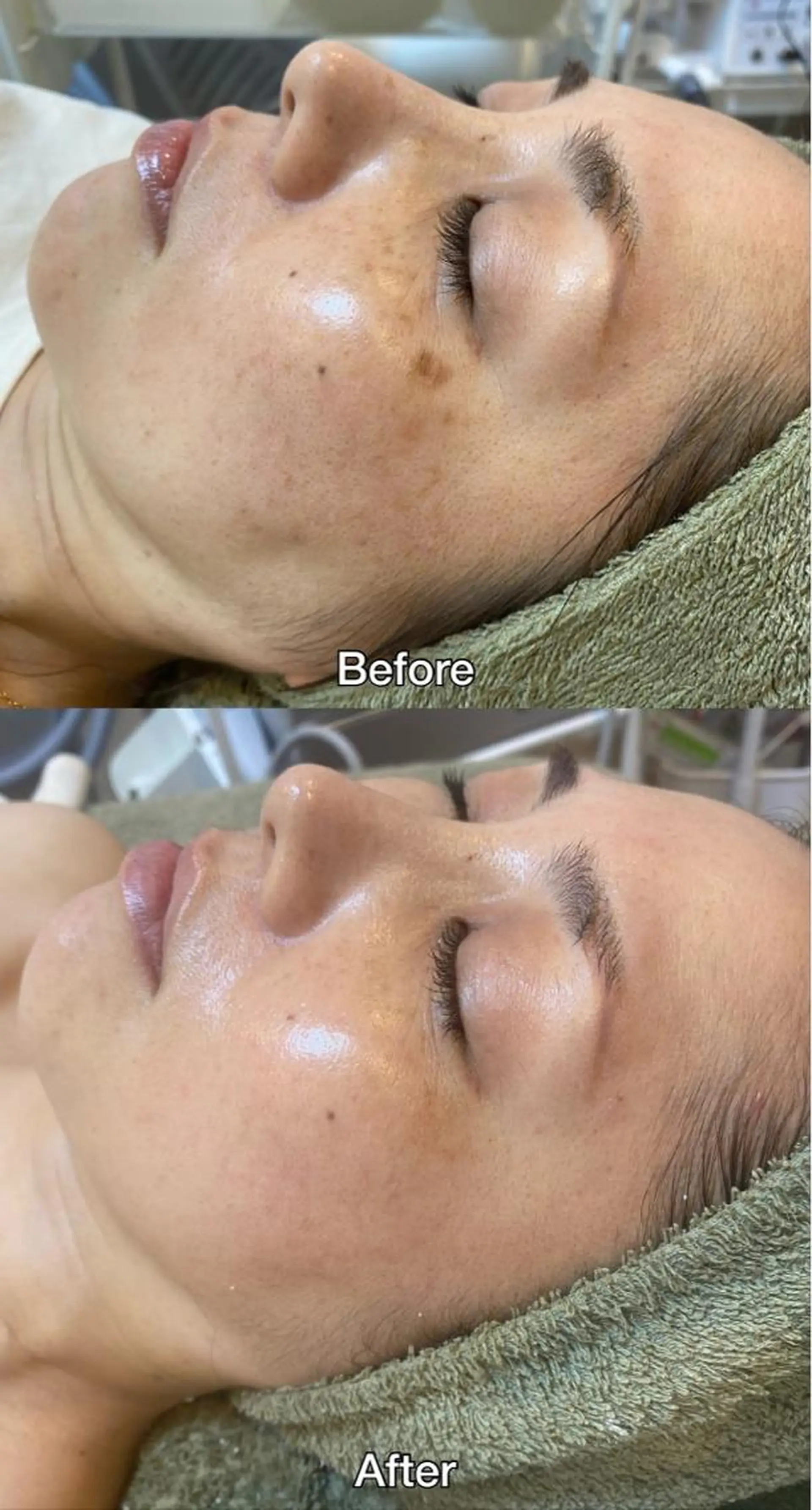 その他 脱毛｜ピーリング ROOM.Sのエステ・リラクイメージ