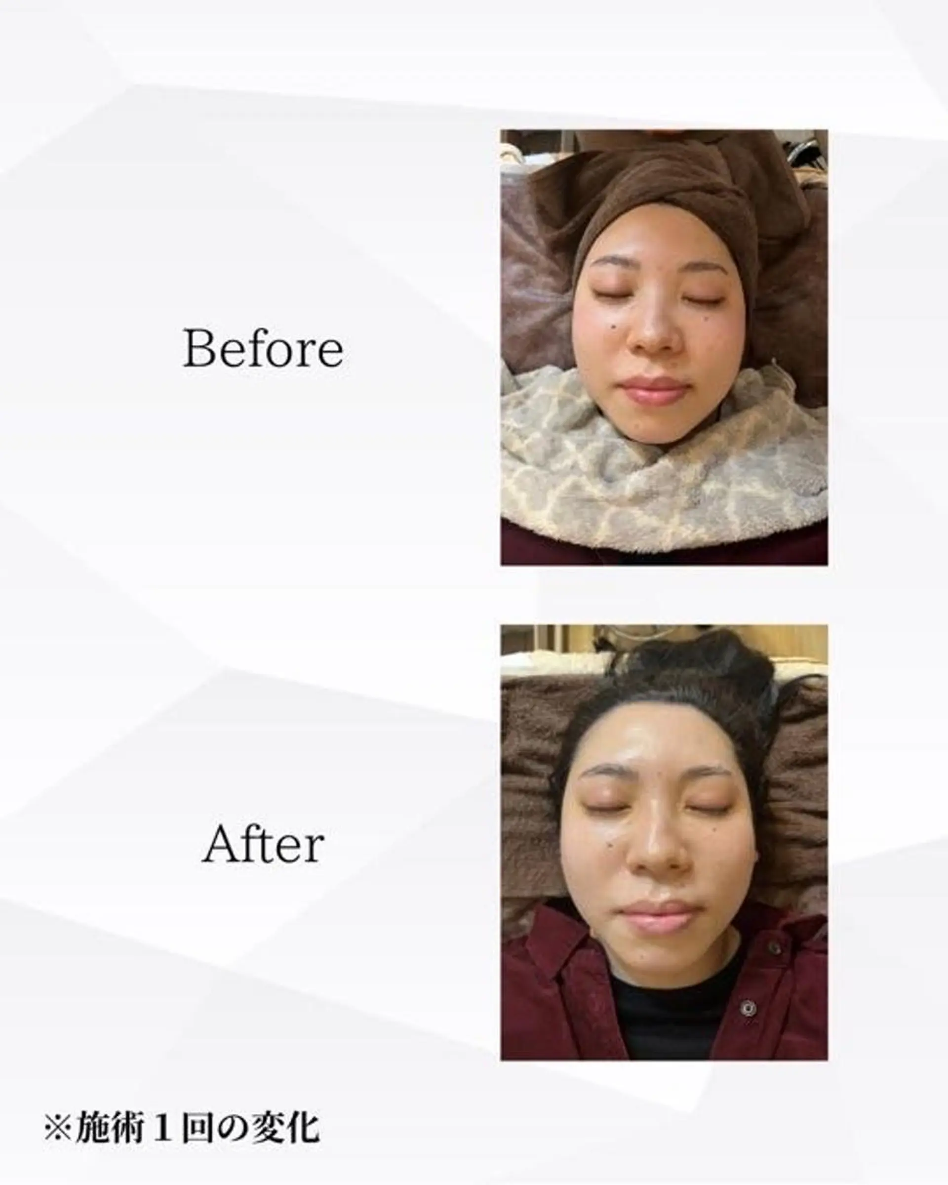 エステ ハーブピーリング🌿 REVI/Ayanoのエステ・リラクイメージ