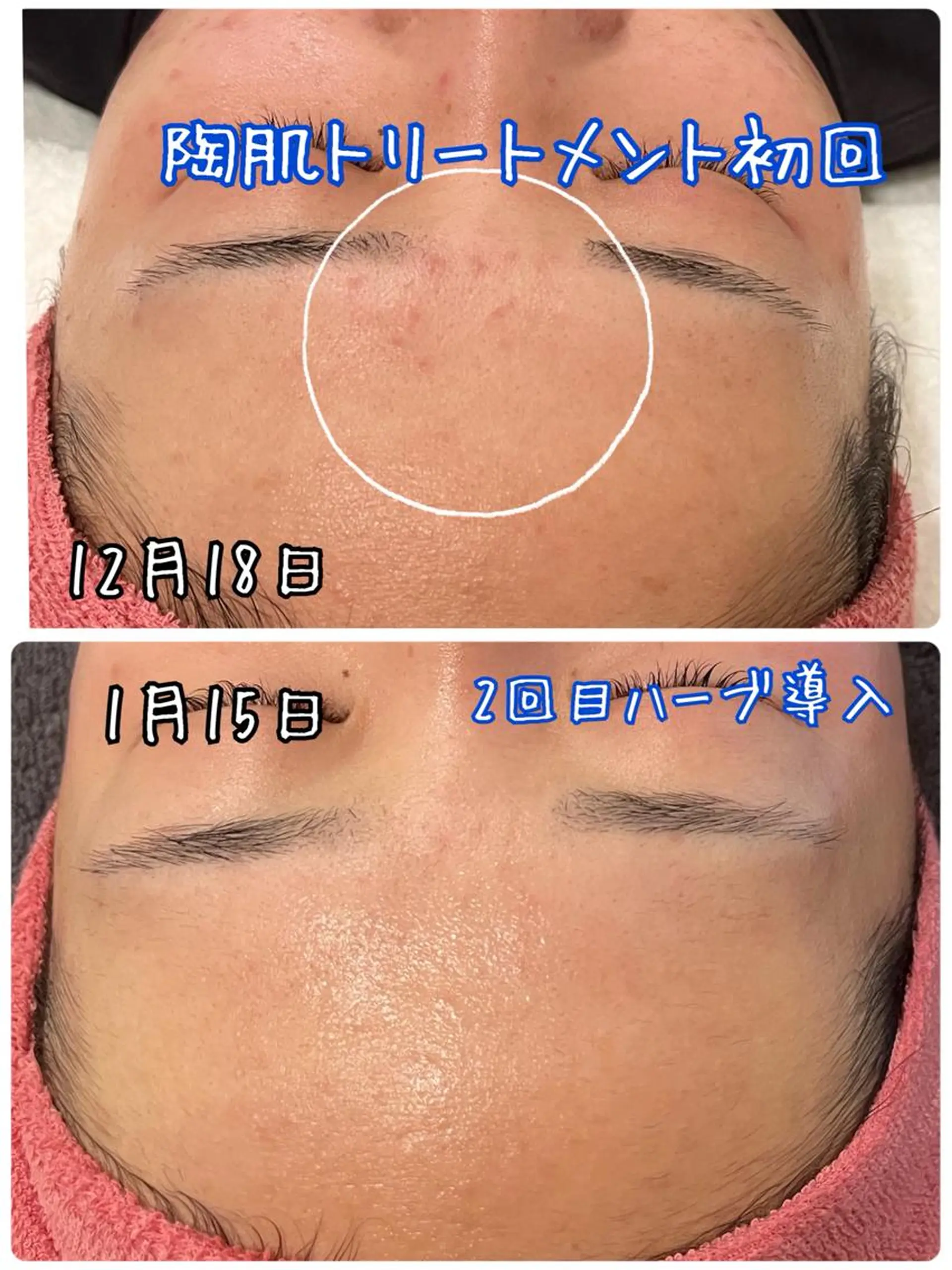 エステ 【リベルハーブピーリング認定店】敏感肌・美白脱毛専門店Dione立川店所属・Dione 立川店のエステ・リラクイメージ