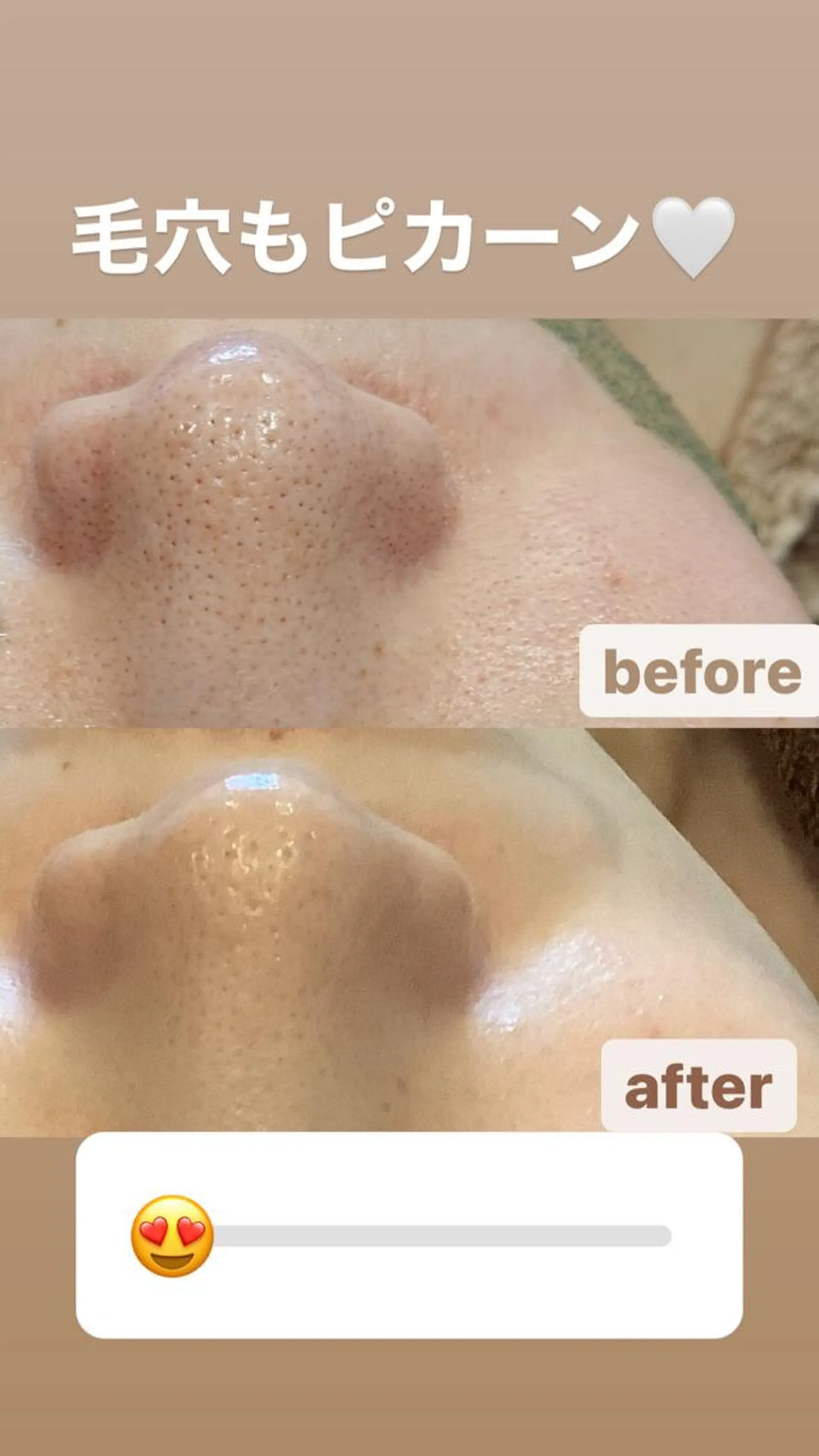 ニキビ・毛穴改善 🌿ハーブピーリングのエステ・リラクイメージ