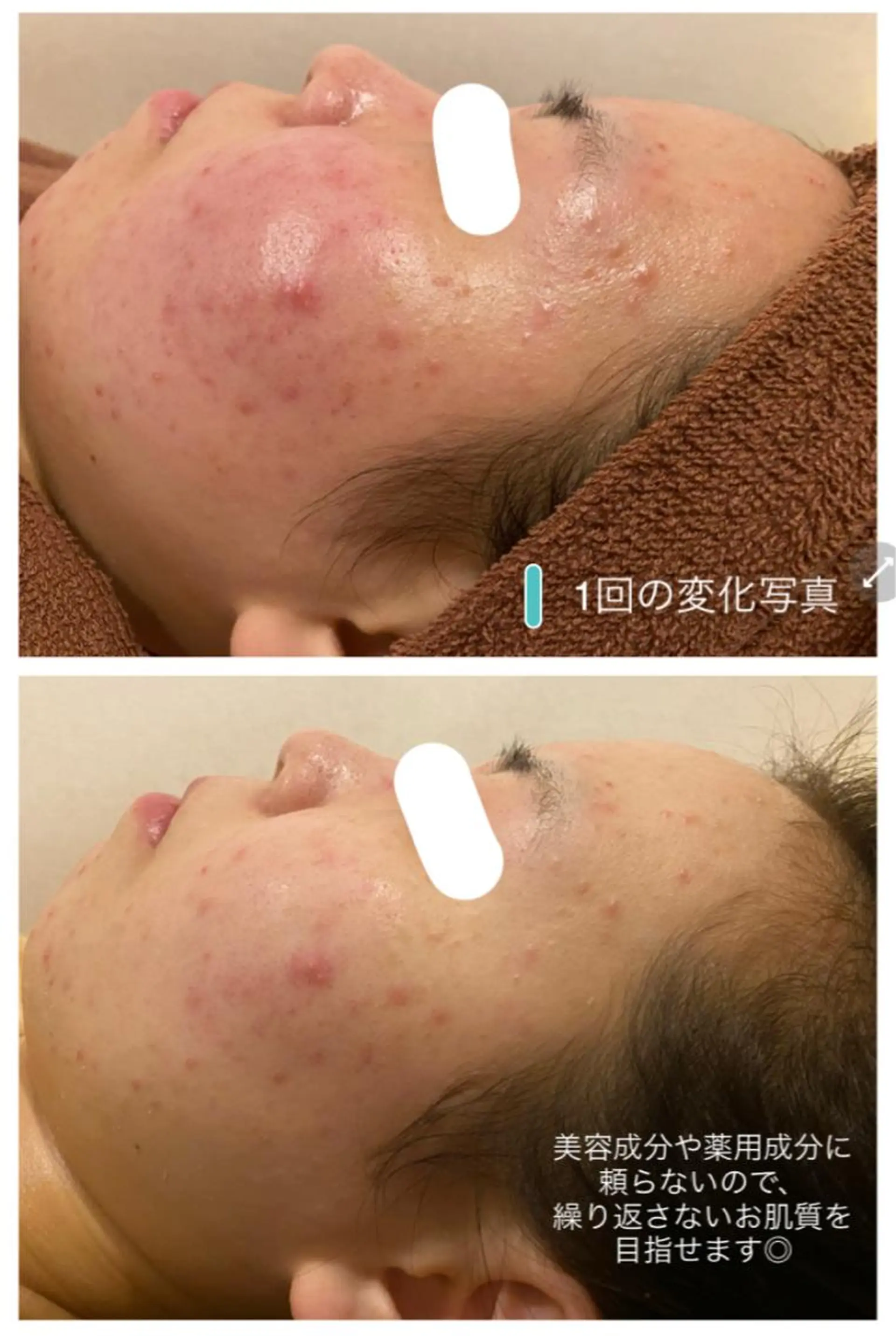 エステ リラク 夏までに肌荒れ卒業 するサロン🌻のエステ・リラクイメージ