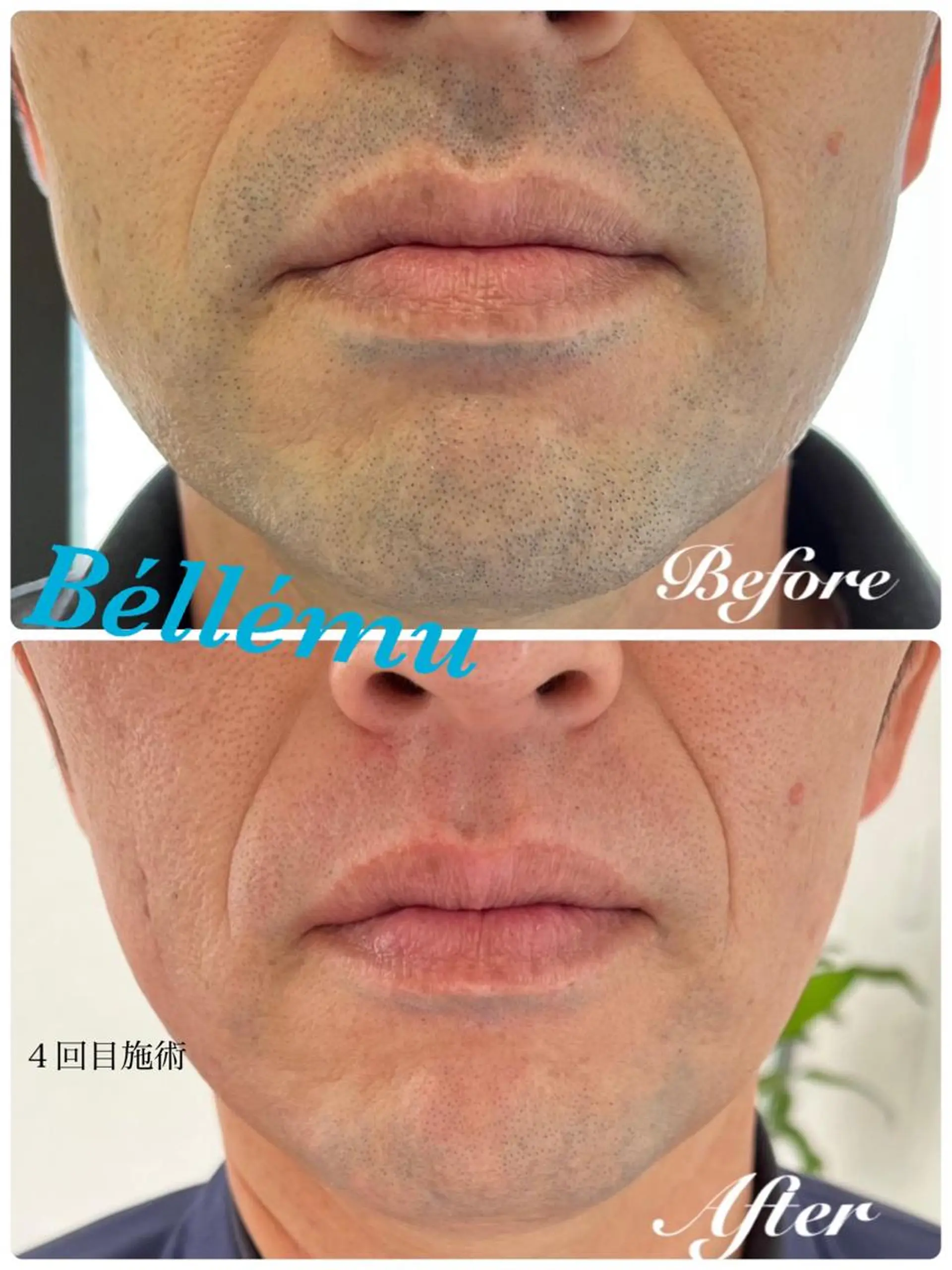 メンズ 脱毛 Salon de Béllému所属・Béllému ﾍﾞﾙｴﾐｭ　あおいのエステ・リラクイメージ