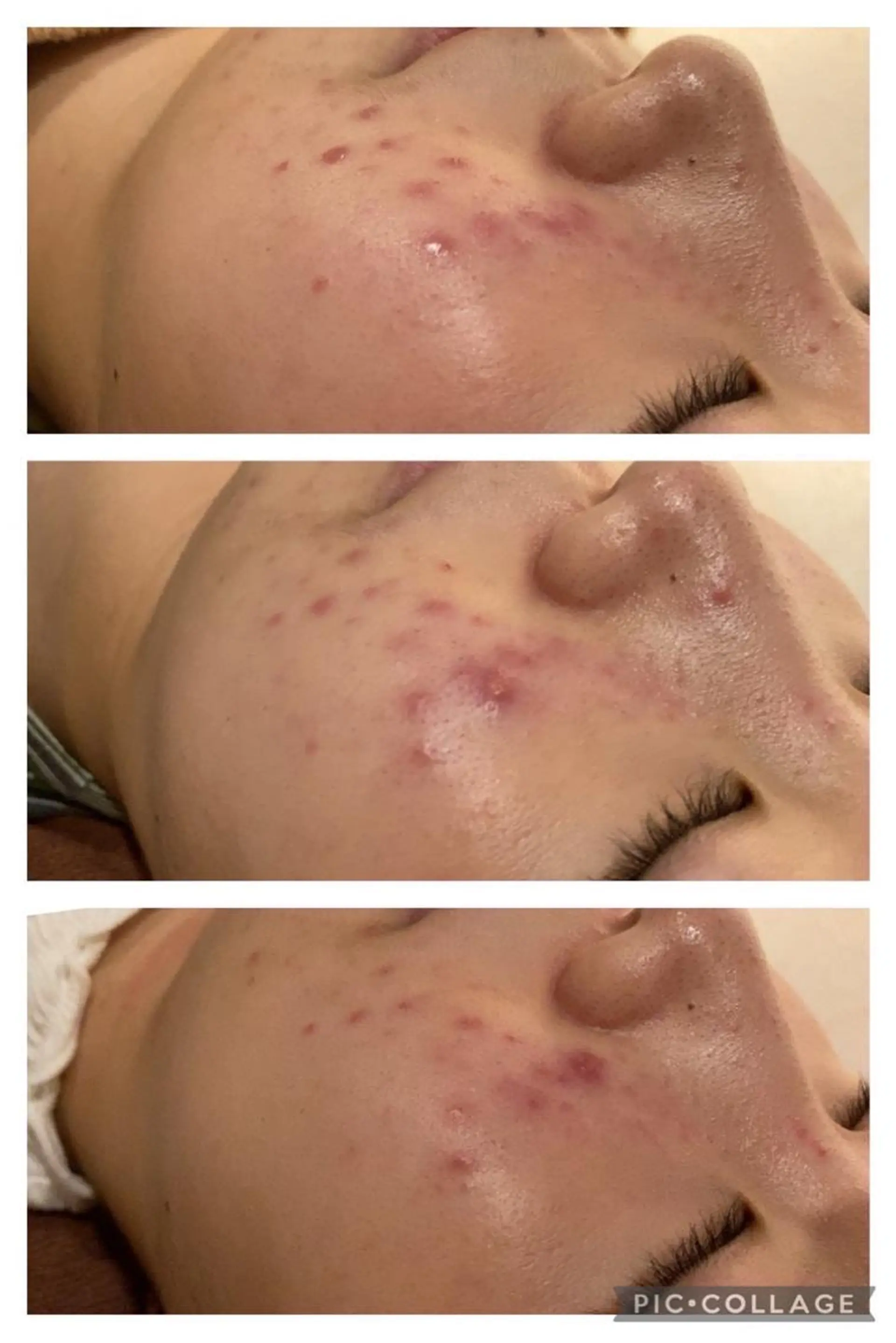 セミロング カラー パーマ ヘアアレンジ メンズ キッズ ネイル マツエク・マツパ アイブロウ エステ リラク ニキビ特化型エステ 🍓最短で肌質改善のエステ・リラクイメージ