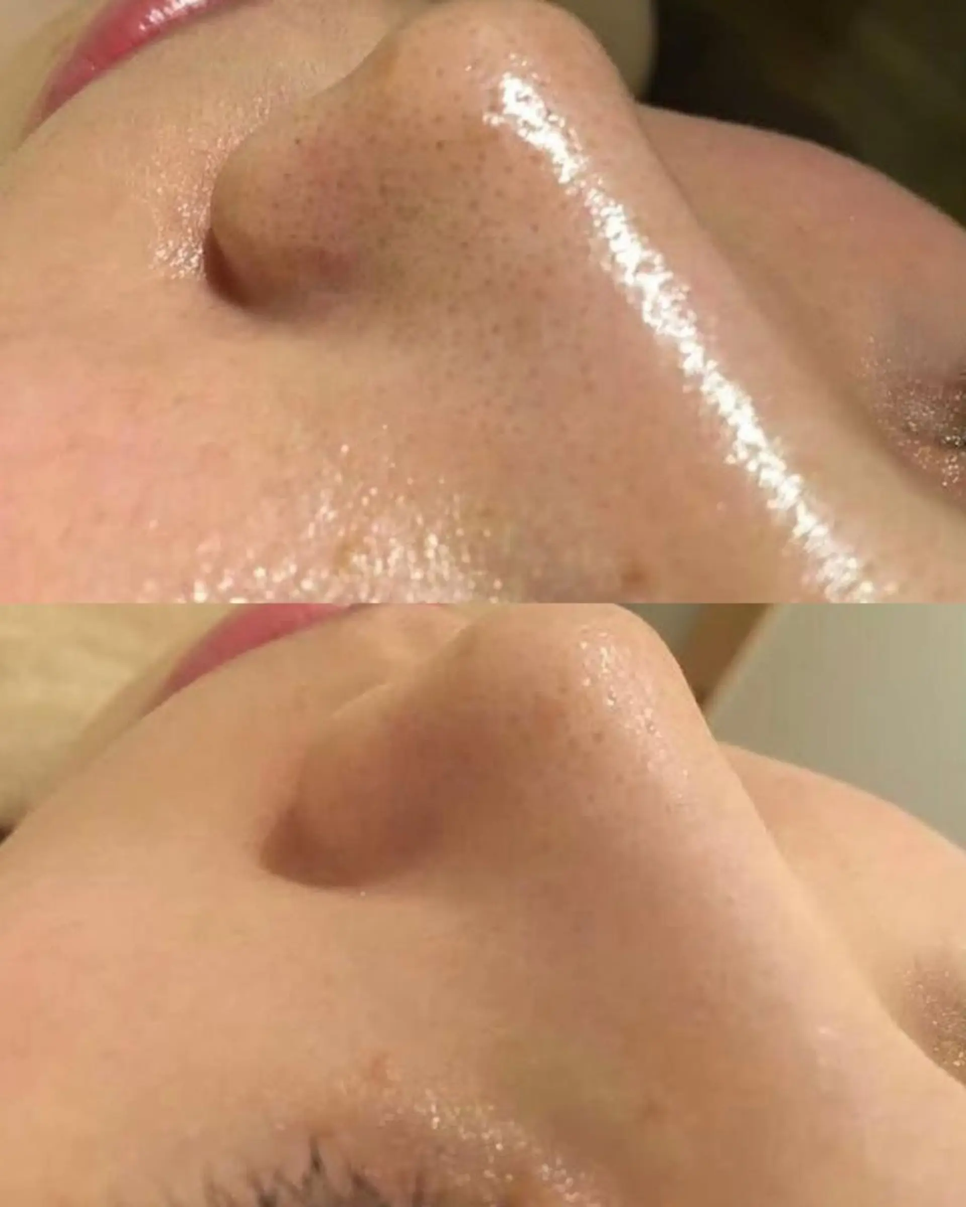 エステ リラク ニキビ特化型エステ 🍓最短で肌質改善のエステ・リラクイメージ