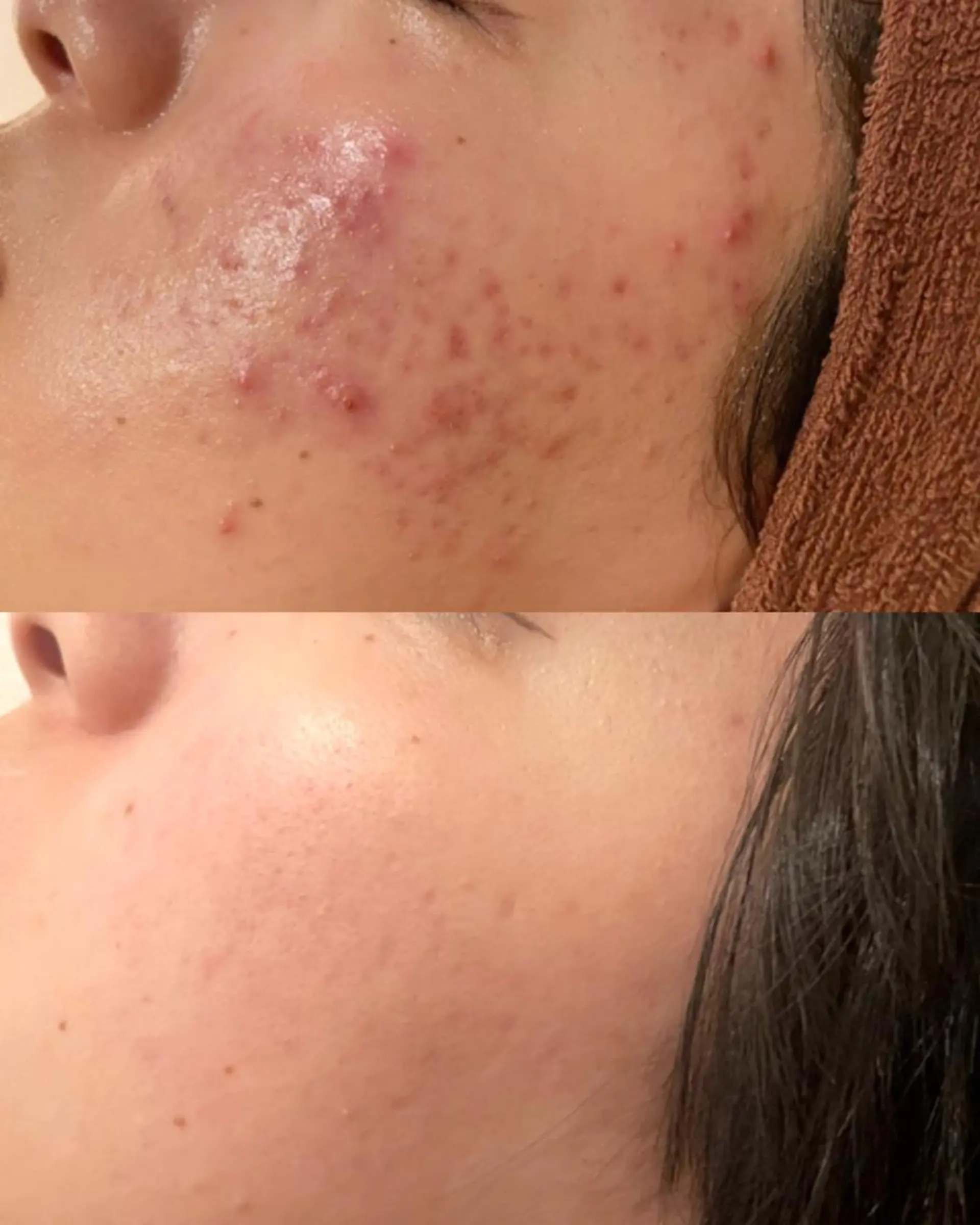 エステ リラク 学生ニキビ改善🍀 優しい肌質改善のエステ・リラクイメージ