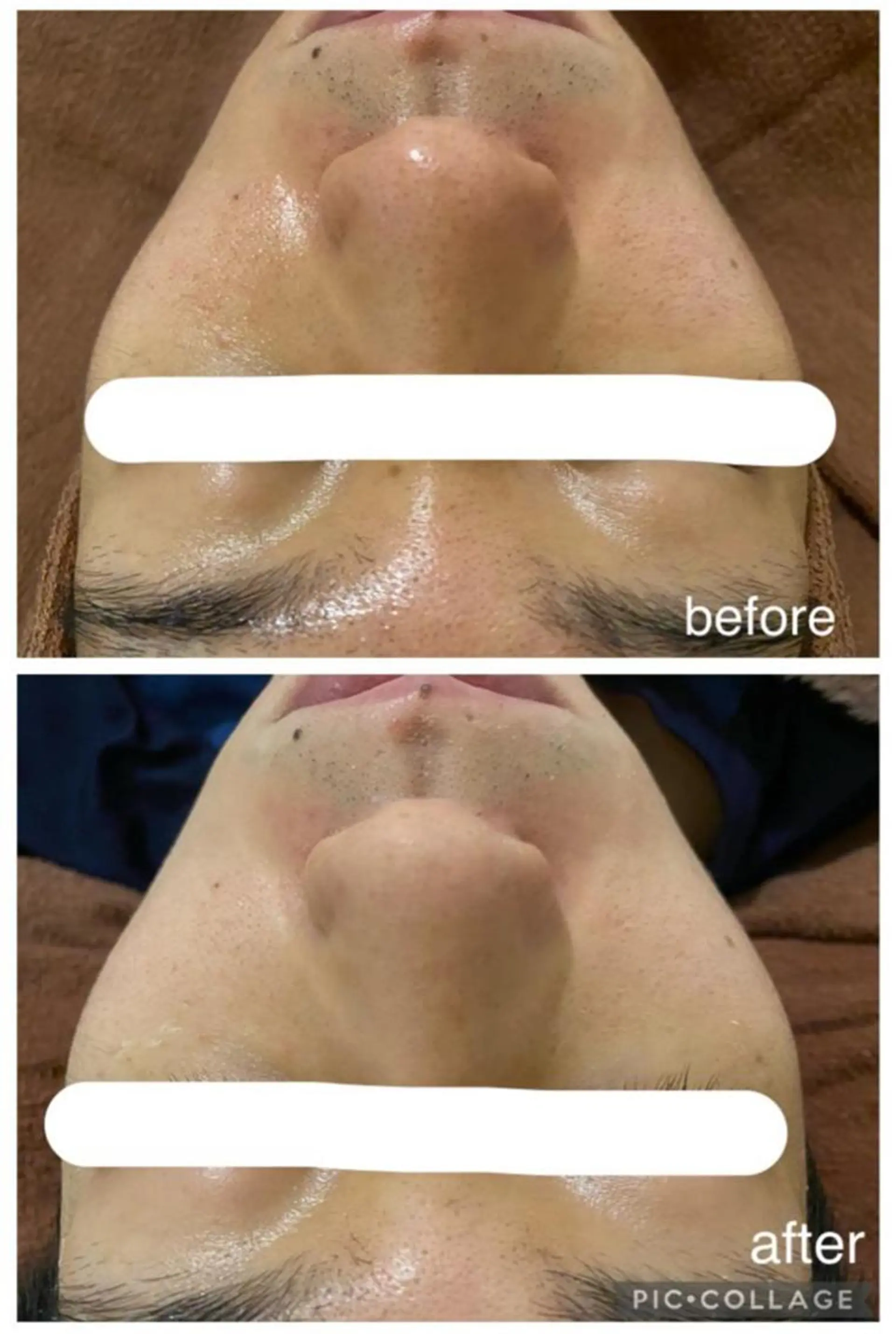 ニキビ特化型エステ 🍓最短で肌質改善のその他イメージ