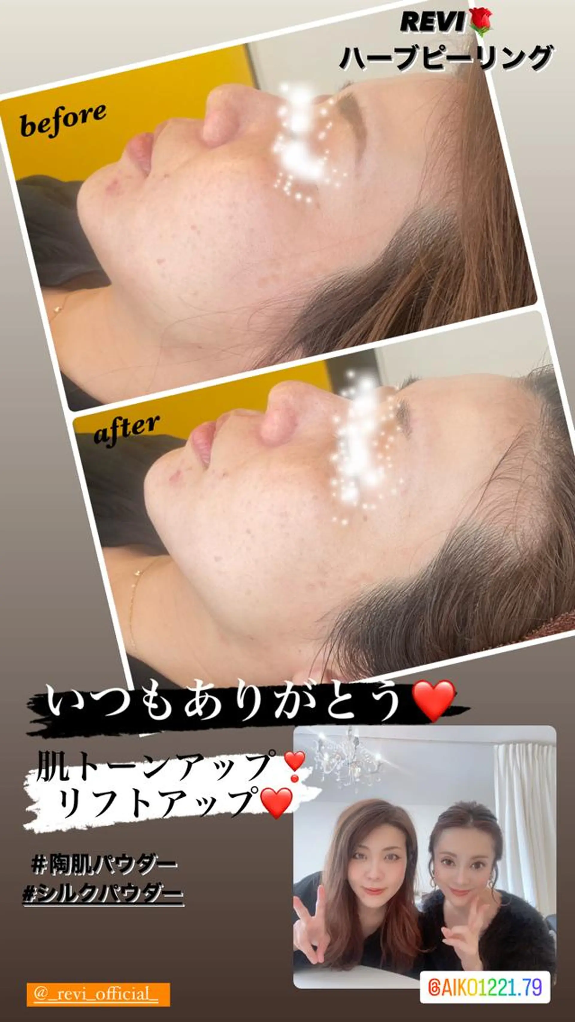 ハーブピーリング/韓国肌管理/フェイシャル/毛穴洗浄/眉毛/顔脱毛【糸脱毛専門】rev所属・ハーブピーリング🌹 毛穴洗浄❤️眉waxのエステ・リラクイメージ