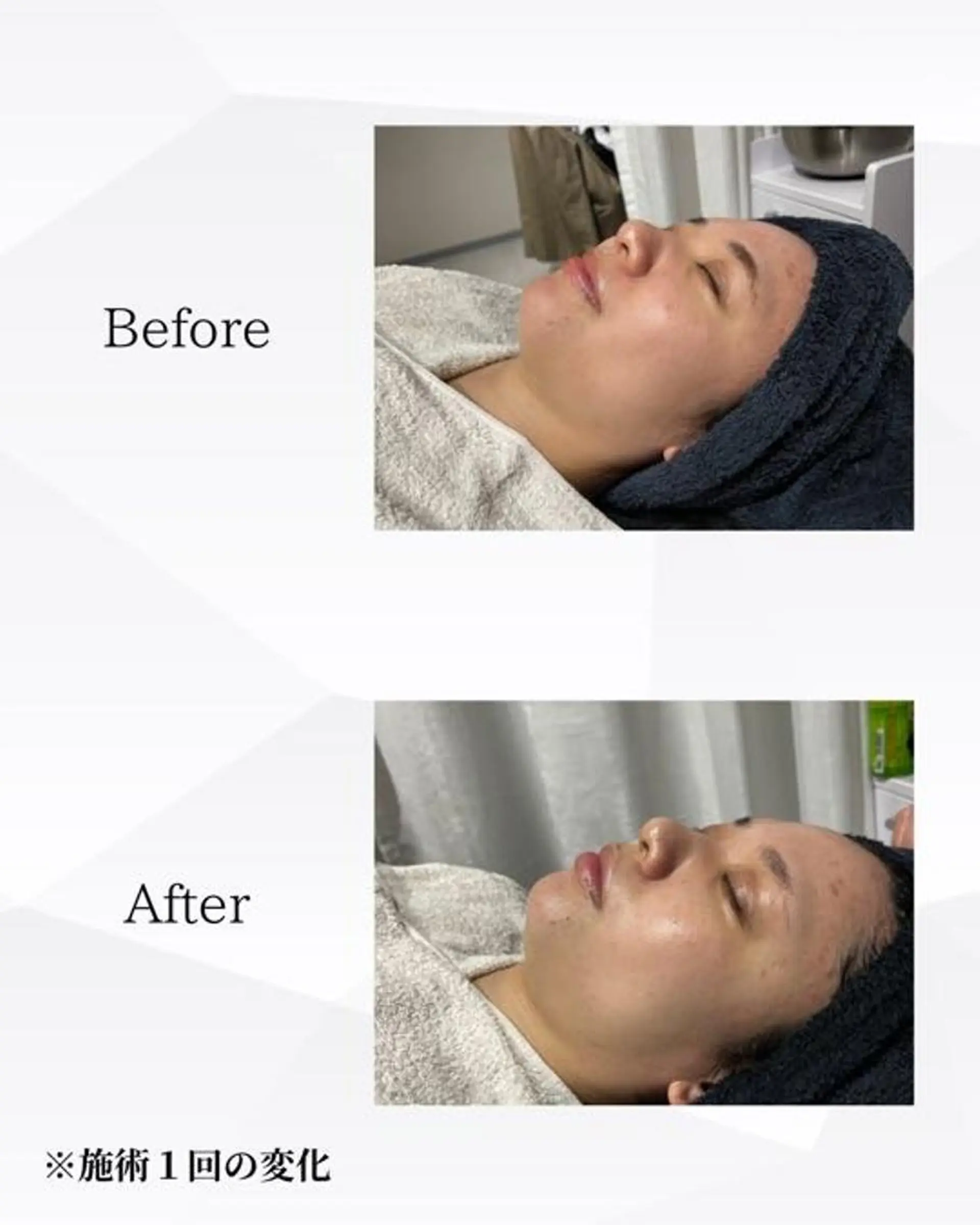 エステ ハーブピーリング🌿 REVI/Ayanoのエステ・リラクイメージ