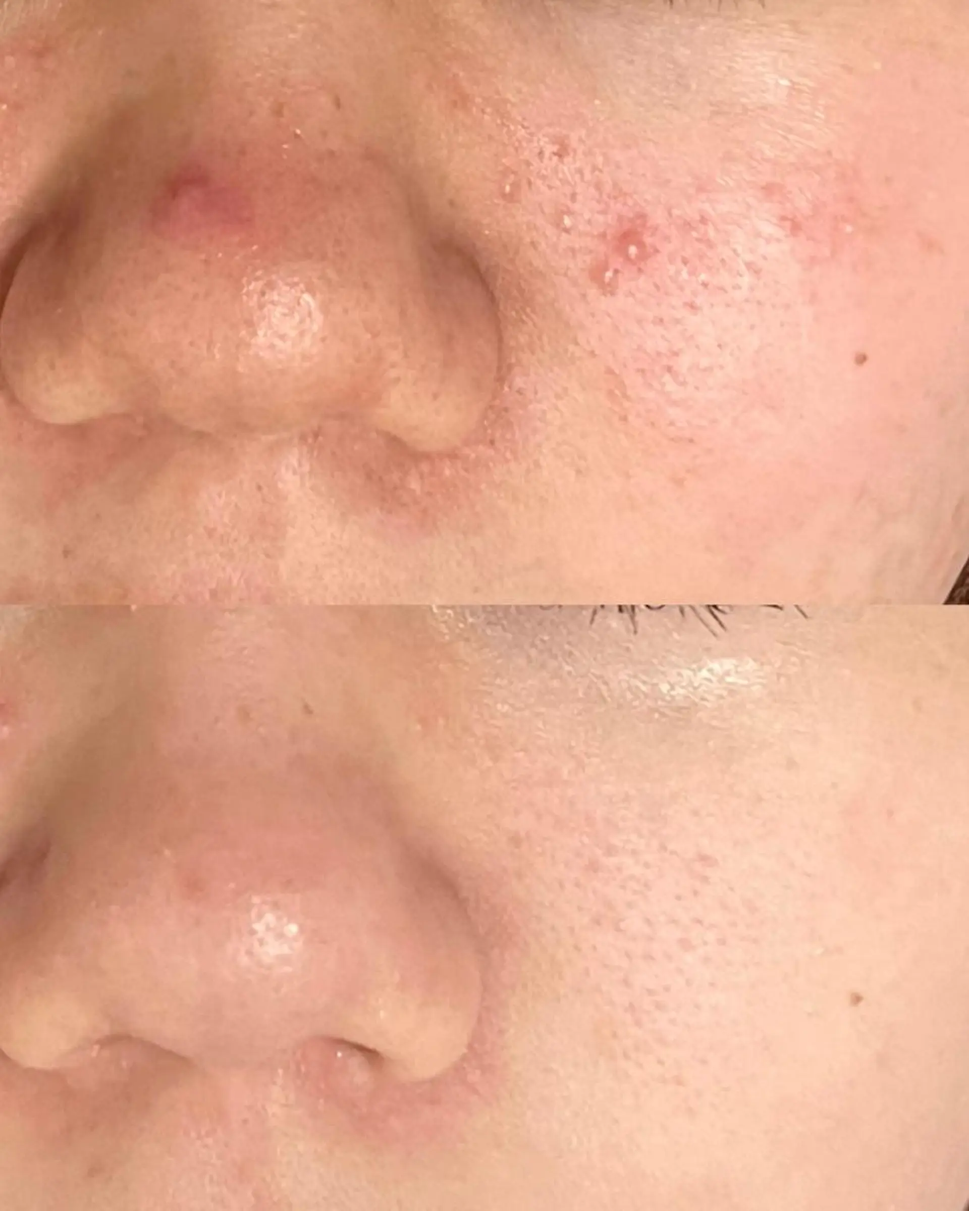 エステ リラク 🔥3か月で肌革命 🔥ニキビ専門店のエステ・リラクイメージ