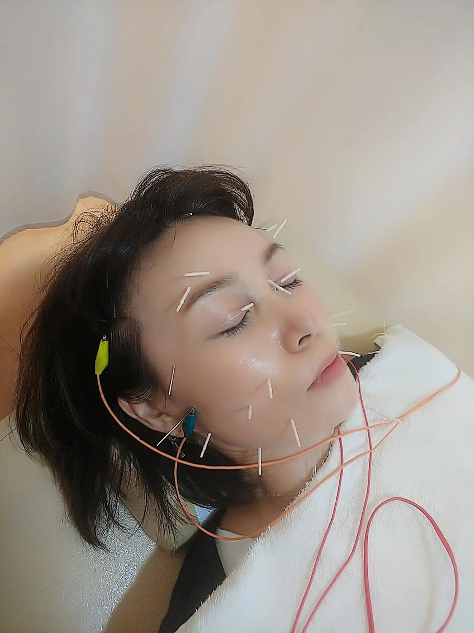 リフトアップ・たるみ ☆美容鍼小顔矯正のその他イメージ