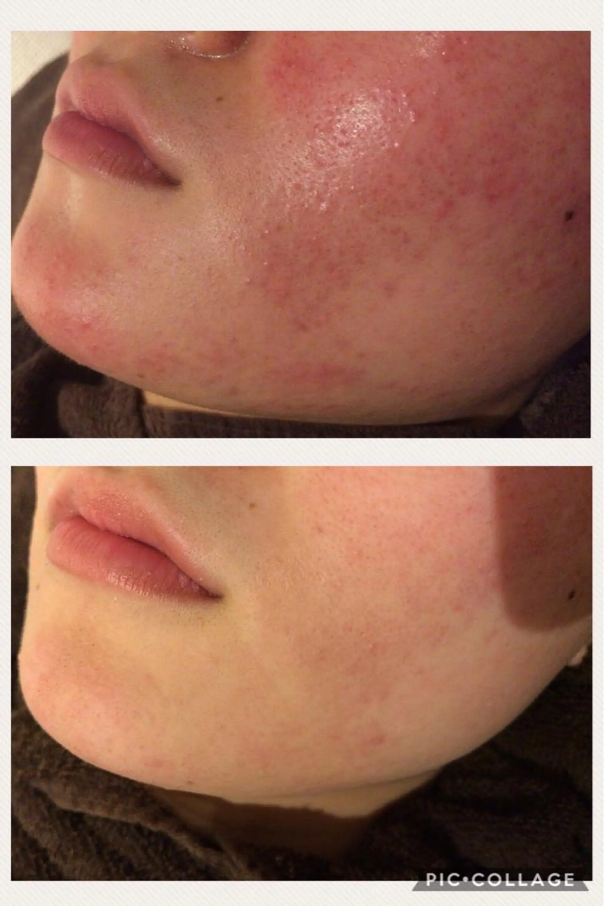 セミロング カラー パーマ ヘアアレンジ メンズ キッズ ネイル マツエク・マツパ アイブロウ エステ リラク 🔥3か月で肌革命 🔥ニキビ専門店のエステ・リラクイメージ